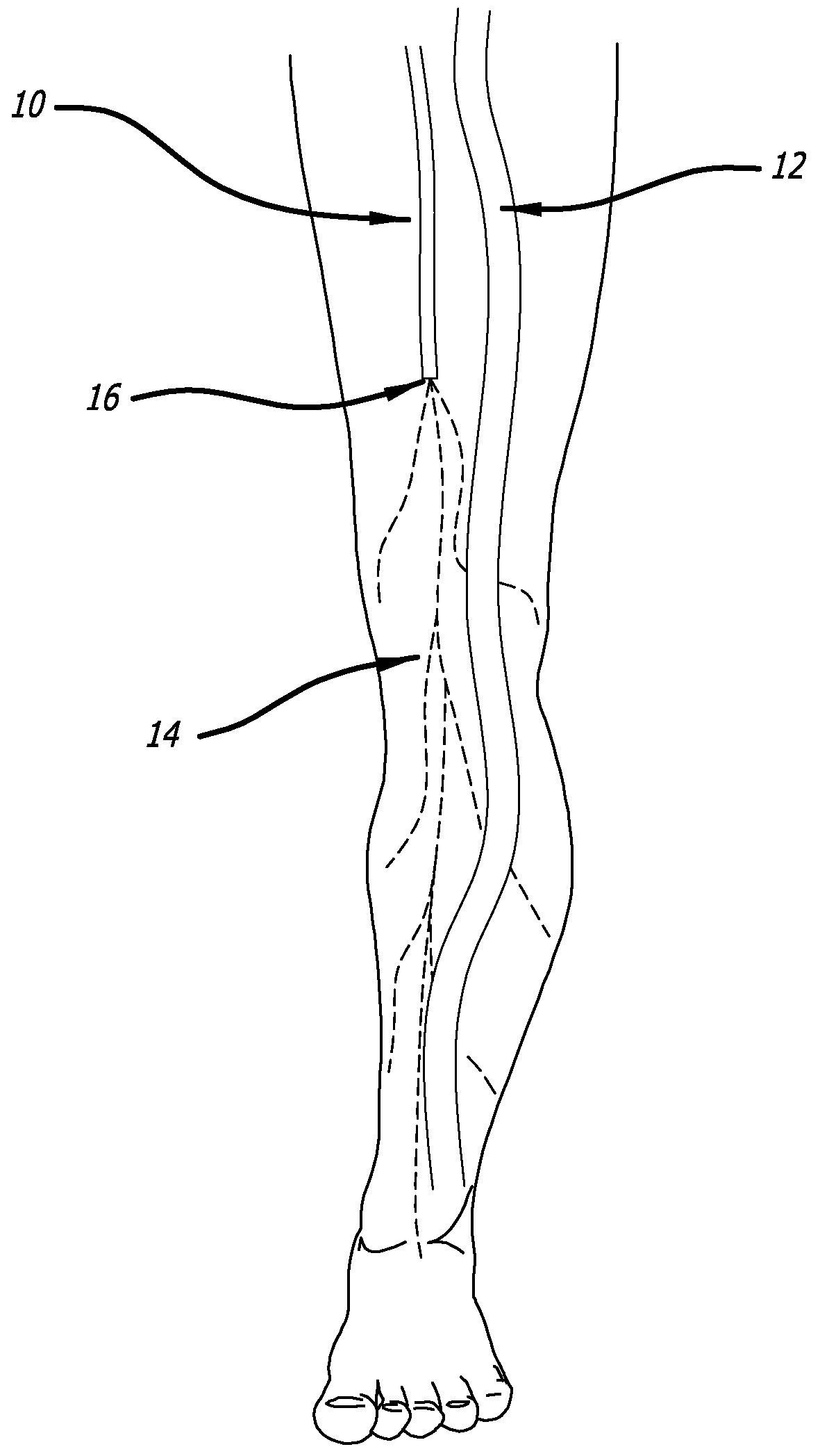 Methods and Systems for Improving Tissue Perfusion