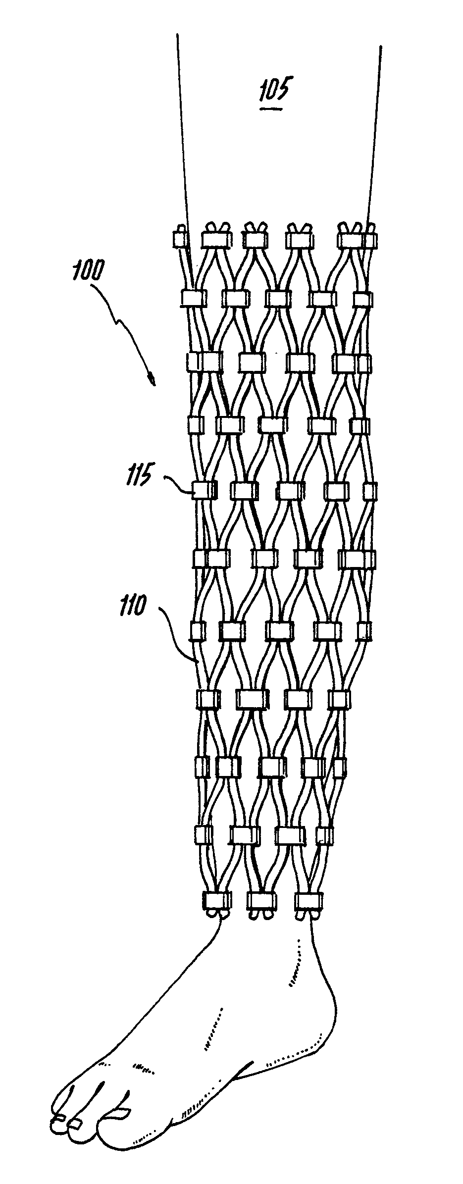 Orthopedic Cast