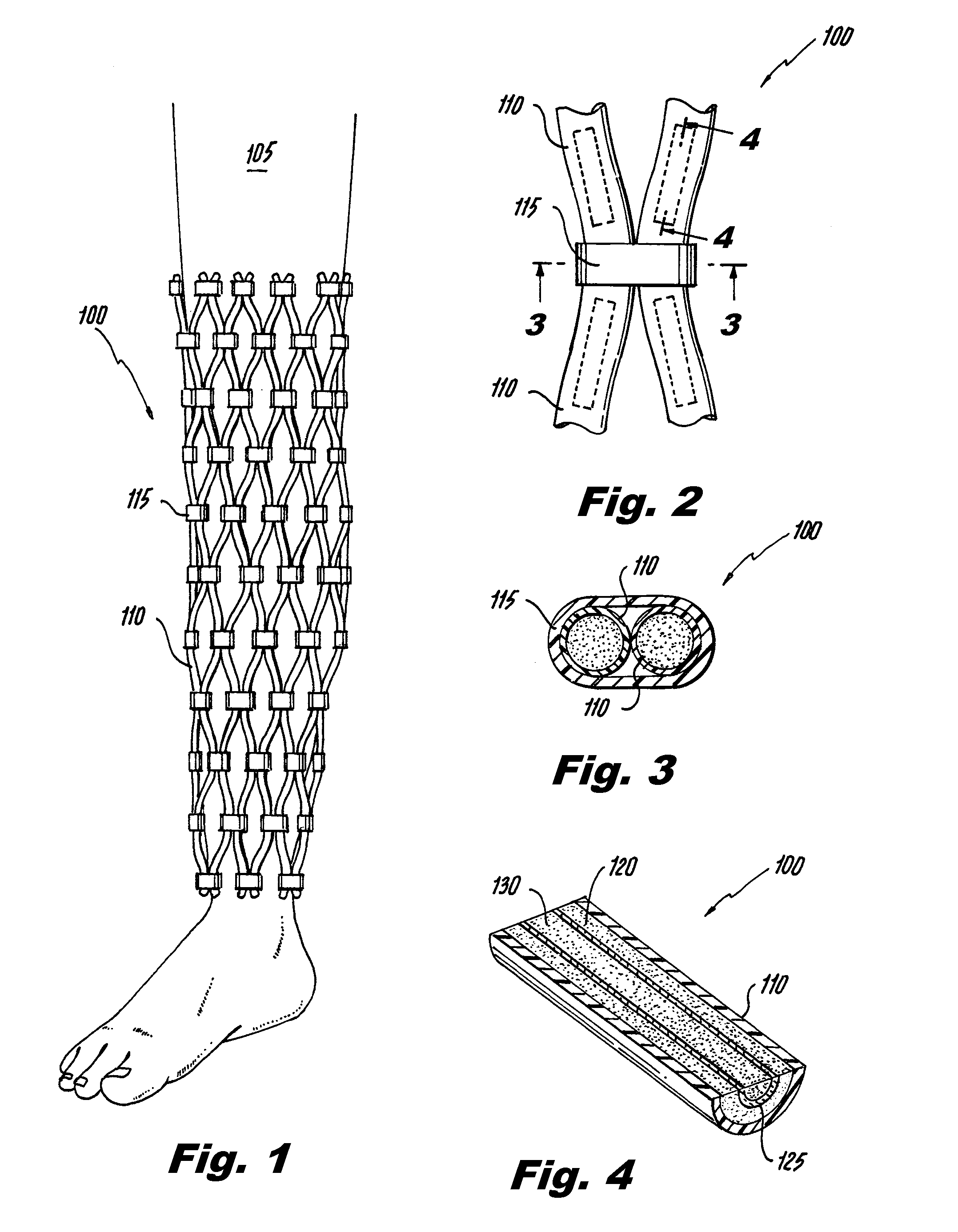 Orthopedic Cast