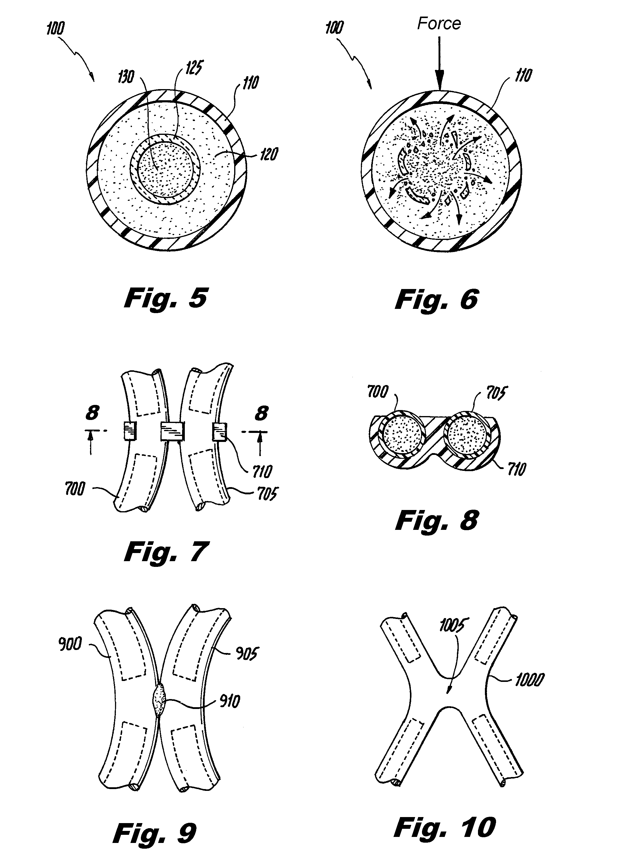 Orthopedic Cast