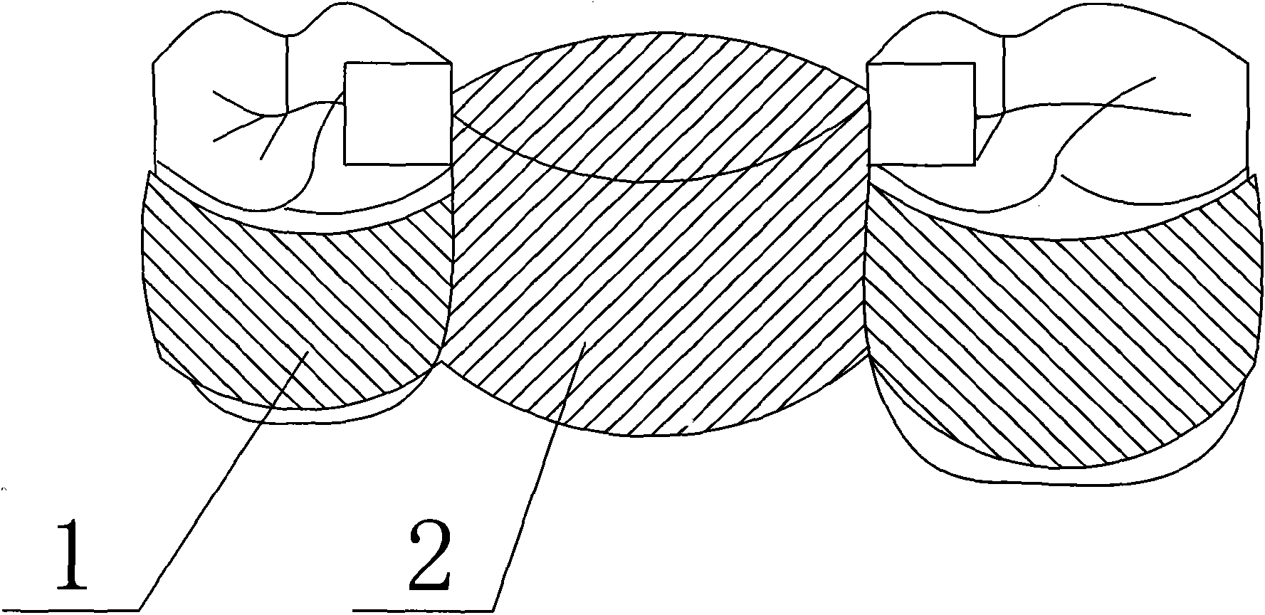 Method for using constraint bonded-bridge type artificial tooth