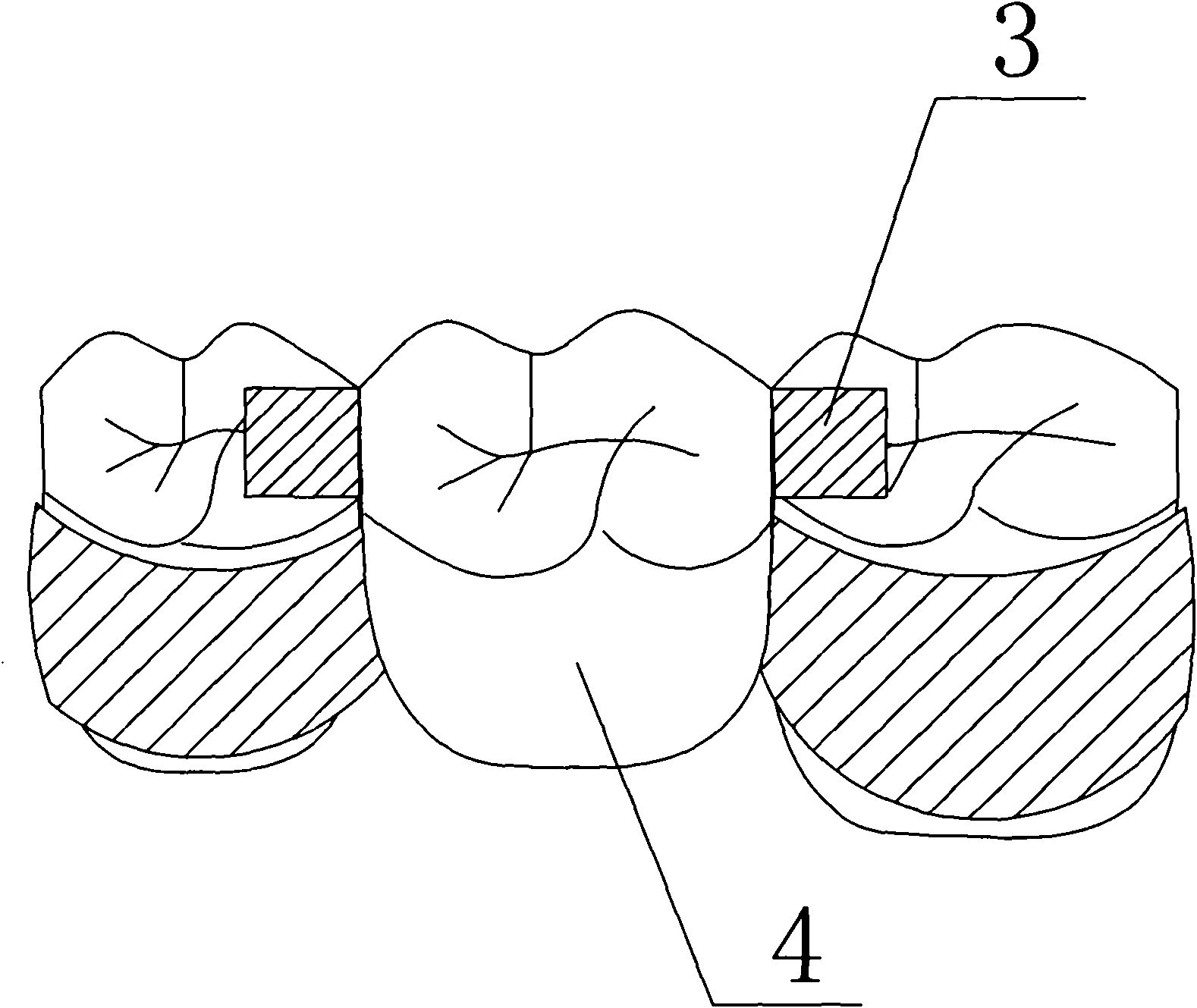 Method for using constraint bonded-bridge type artificial tooth