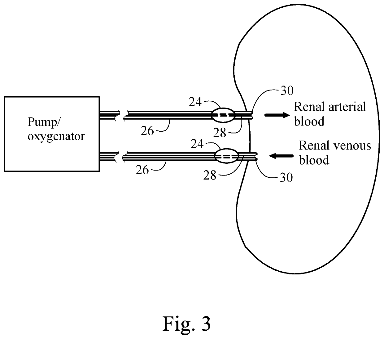 Method for preventing contrast induced nephropathy