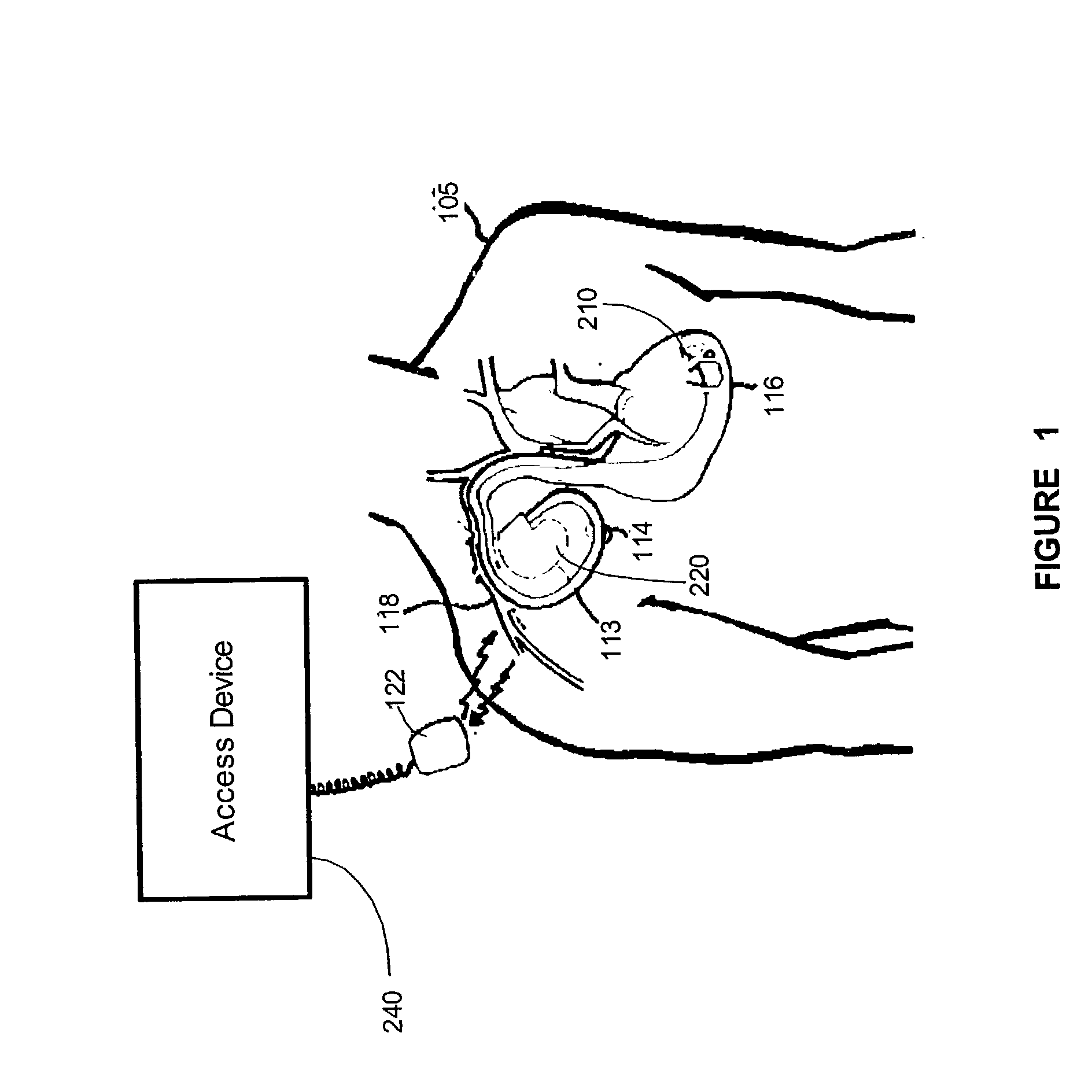 Method and apparatus to detect and monitor the frequency of obstructive sleep apnea