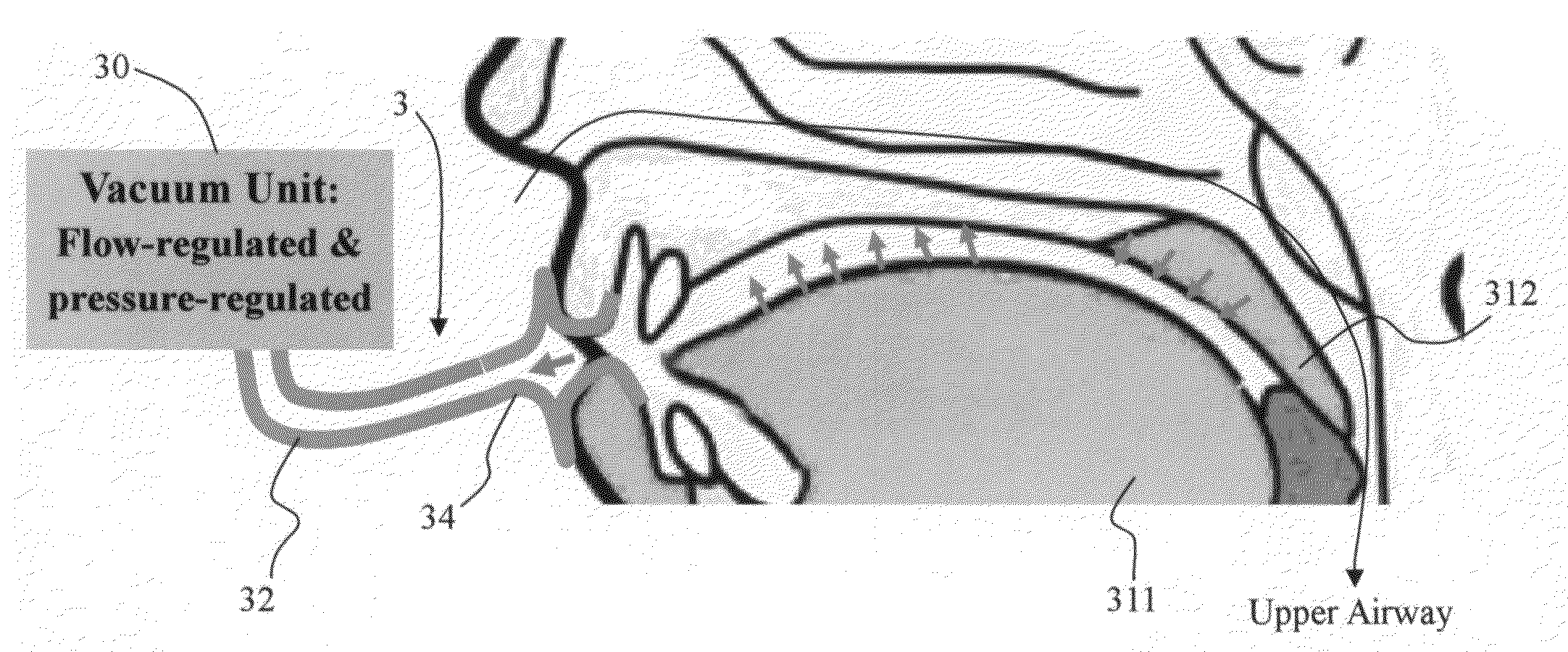 Method and apparatus for treating obstructive sleep apnea by using negative oral pressure to a patient