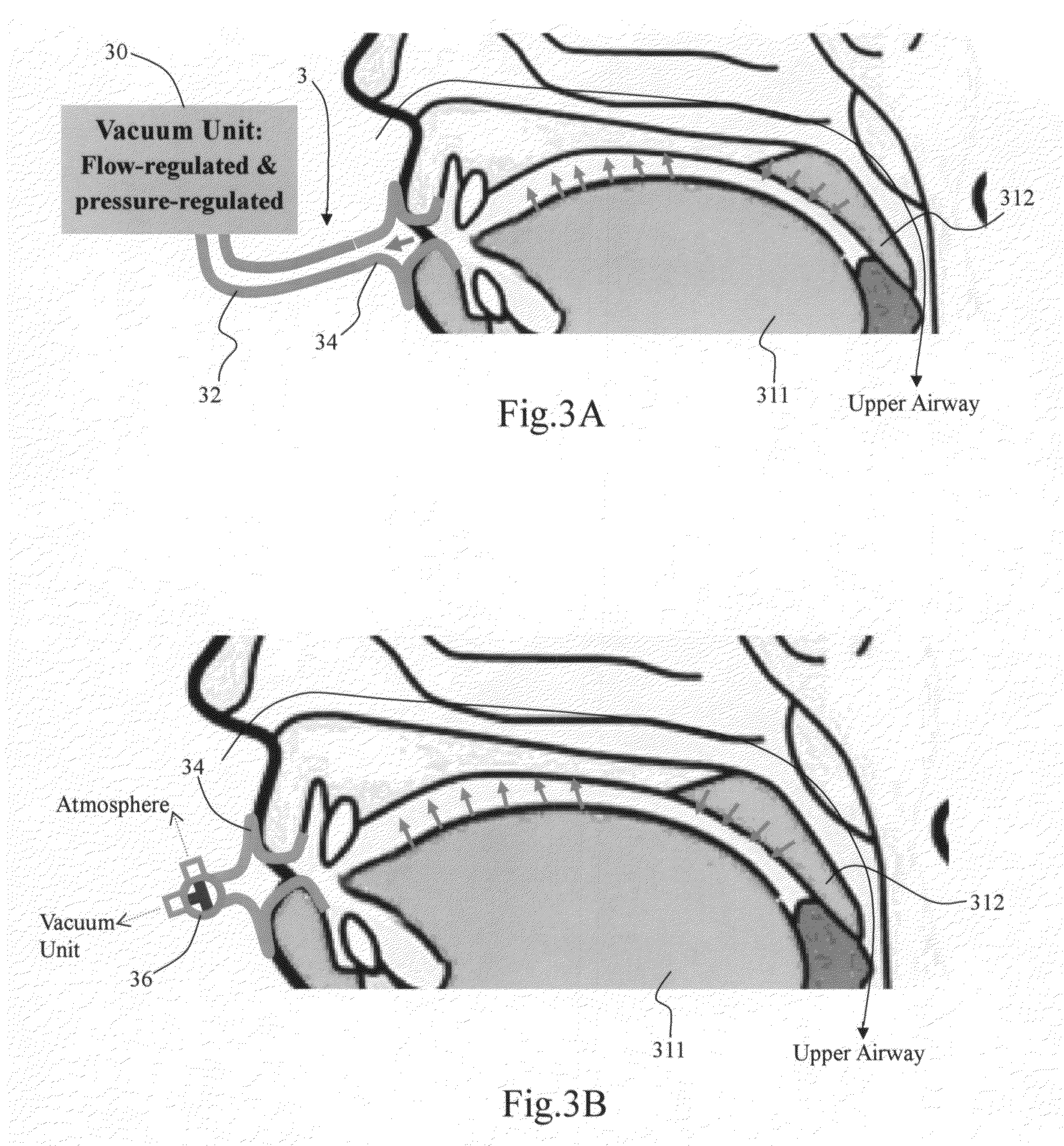 Method and apparatus for treating obstructive sleep apnea by using negative oral pressure to a patient