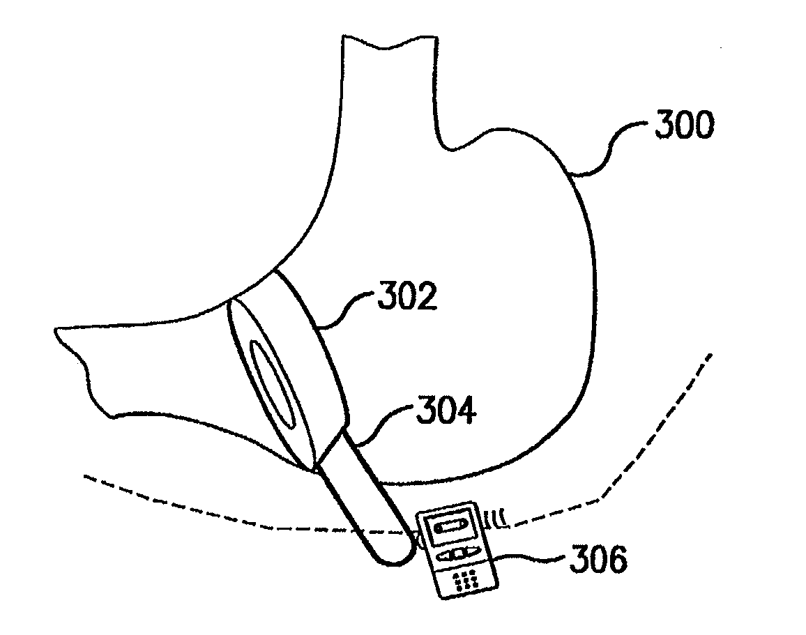 Methods and Devices for Treating Obesity