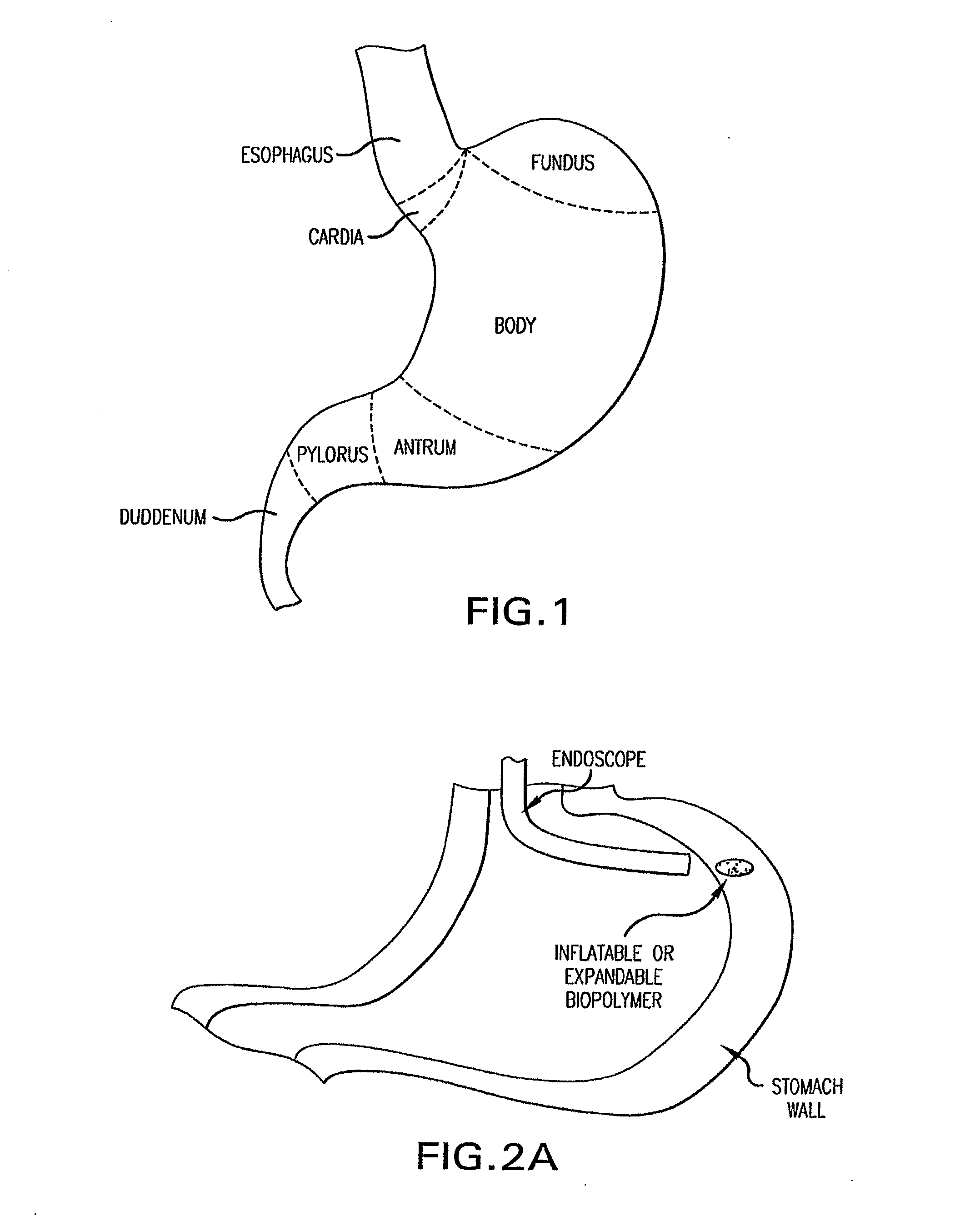 Methods and Devices for Treating Obesity