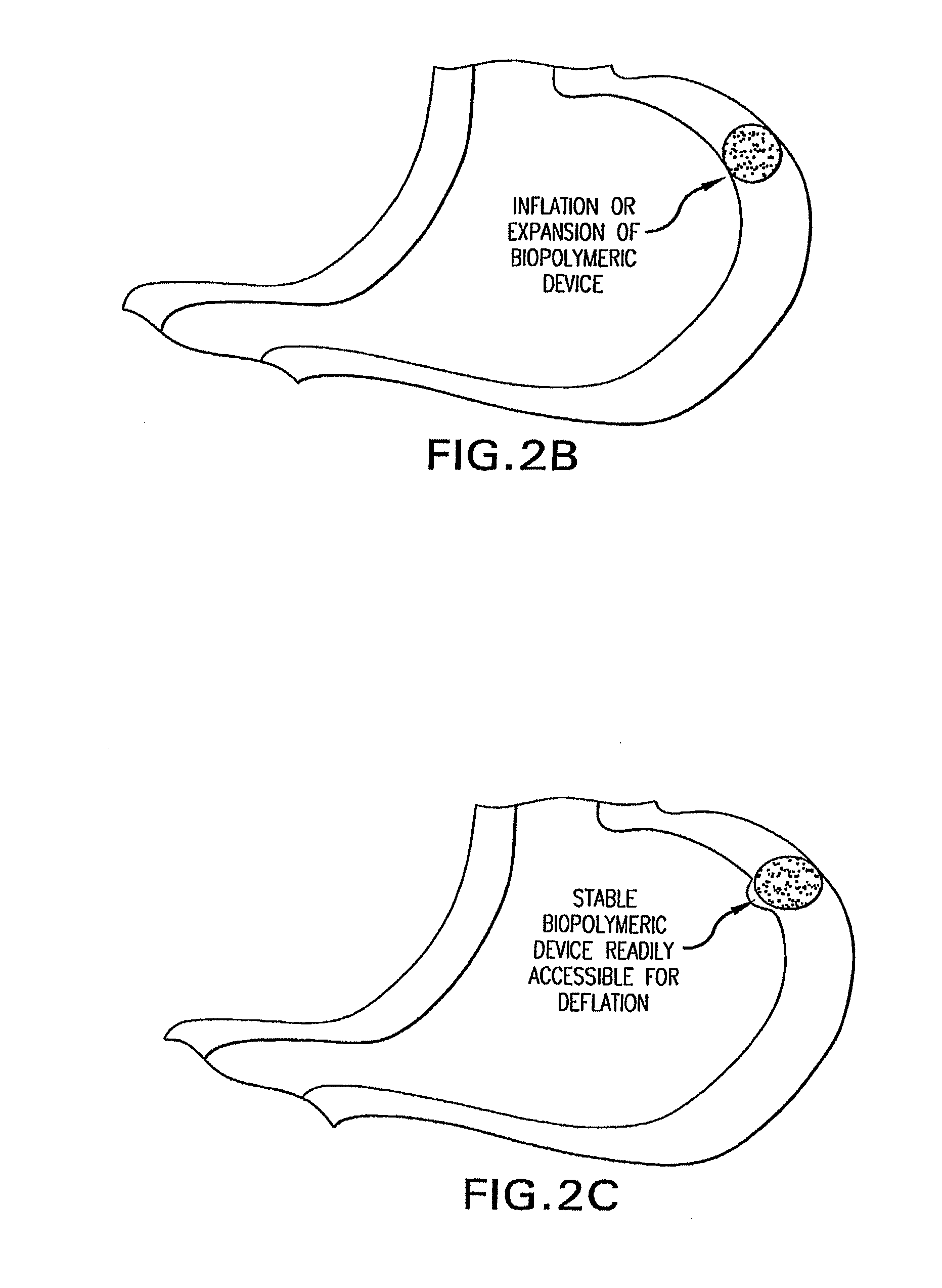 Methods and Devices for Treating Obesity