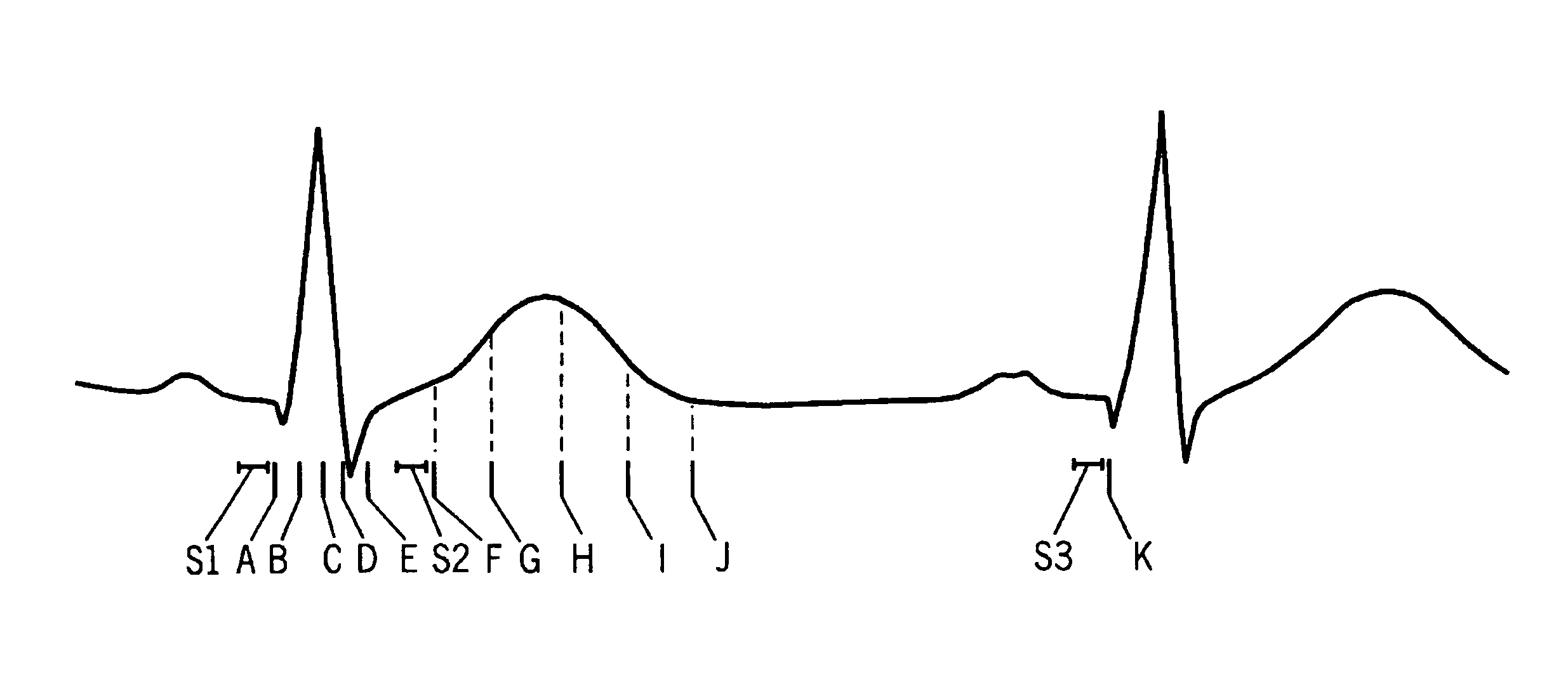 Method and apparatus to optimally measure cardiac depolarization/repolarization instability