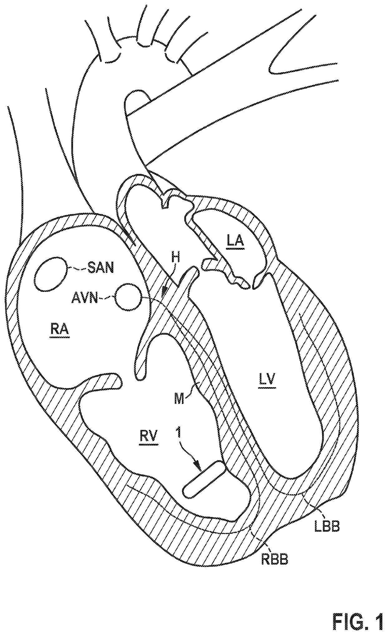 Leadless cardiac pacemaker device configured to provide intra-cardiac pacing