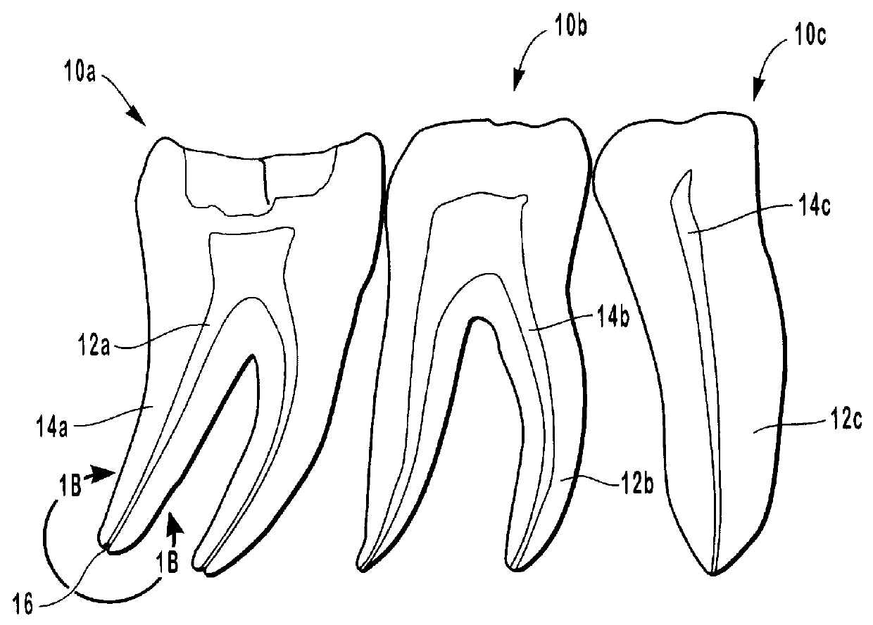 Endodontic systems for the anatomical, sectional and progressive corono-apical preparation of root canals with three sets of dedicated instruments