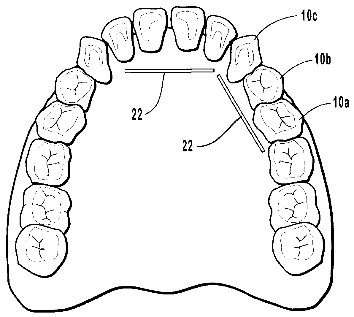 Endodontic systems for the anatomical, sectional and progressive corono-apical preparation of root canals with three sets of dedicated instruments