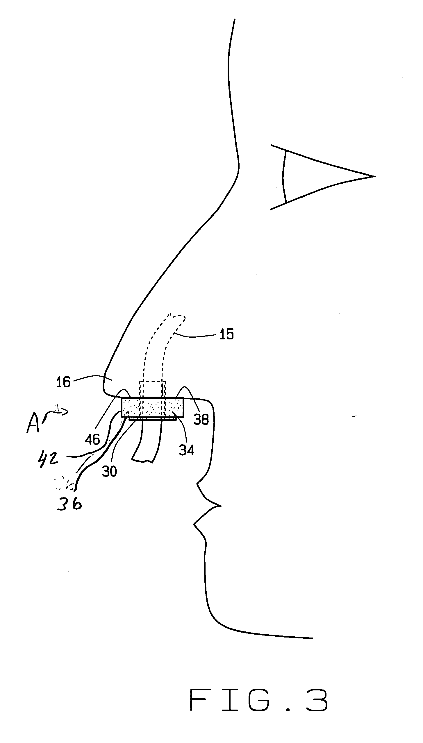 Nasal assembly and method of positioning nasogastric tubing