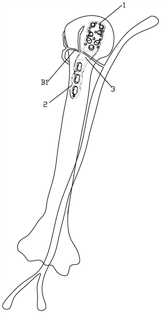 Proximal humeral fracture fixing device and locking plate thereof