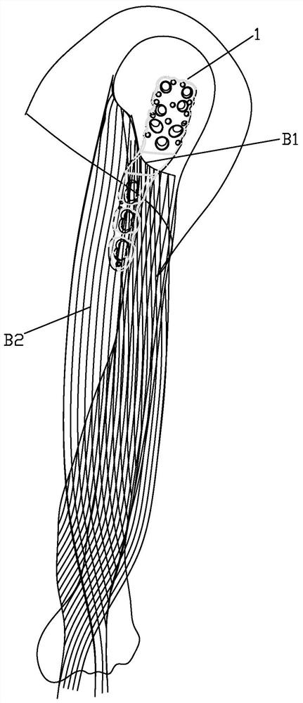 Proximal humeral fracture fixing device and locking plate thereof