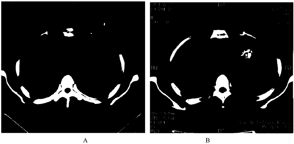 Antigen peptide chain group for curing tumors and application of antigen peptide chain group in medicine