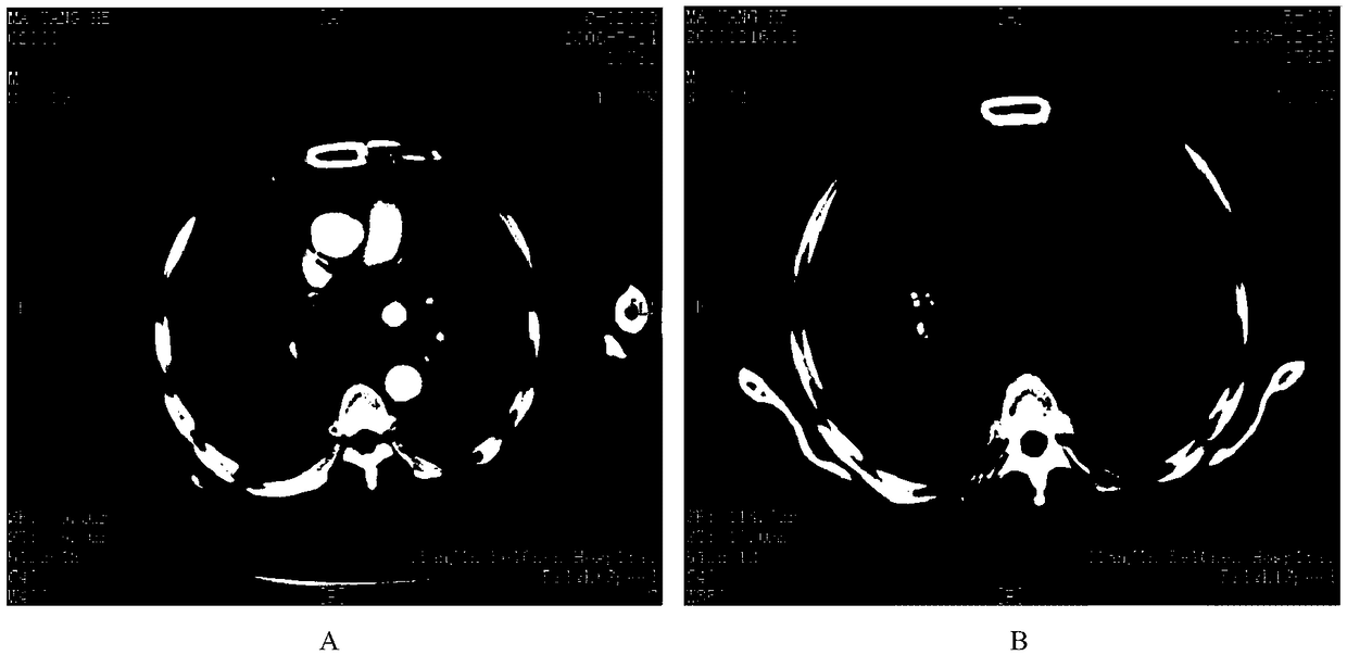 Antigen peptide chain group for curing tumors and application of antigen peptide chain group in medicine