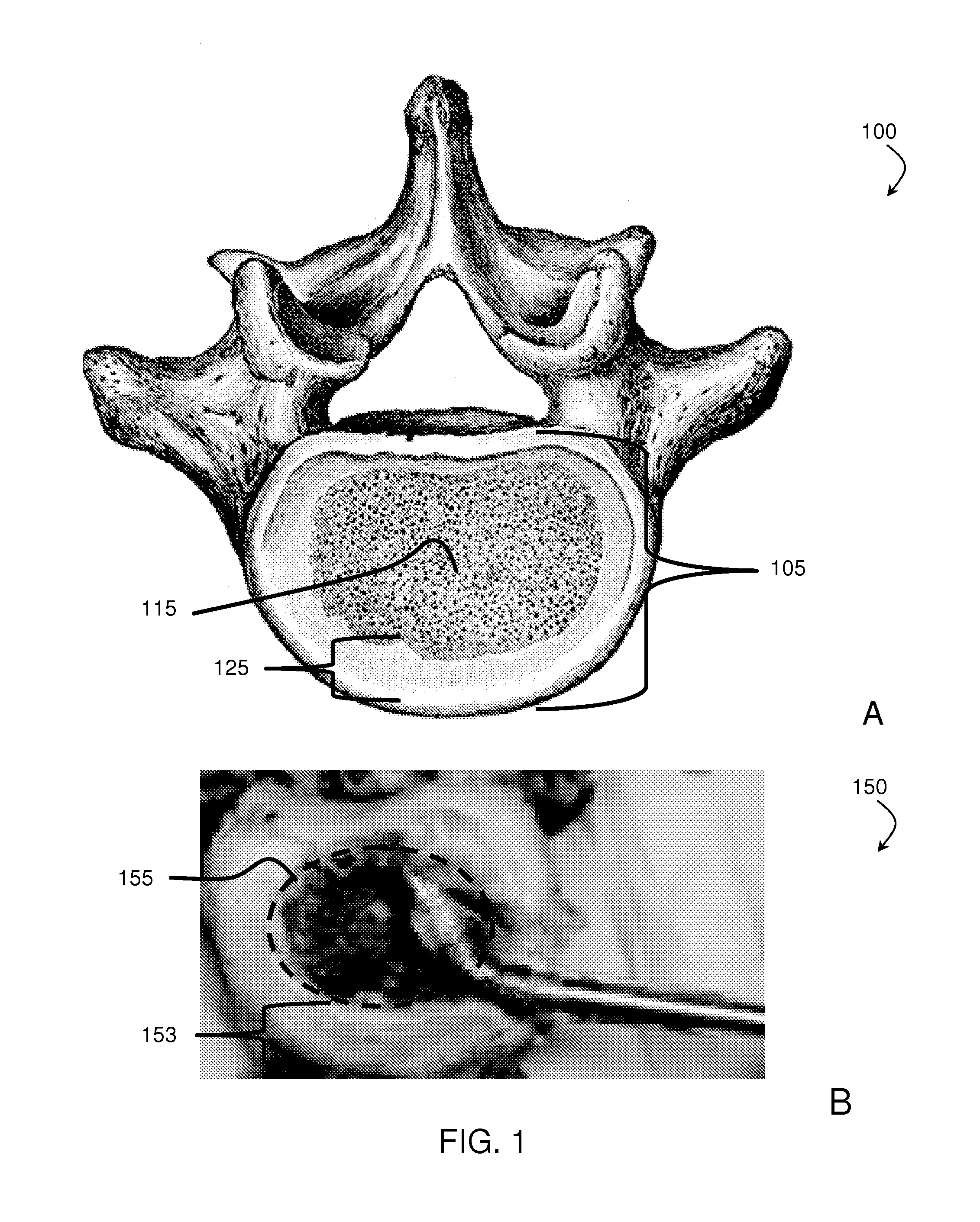 Staged, bilaterally expandable trial