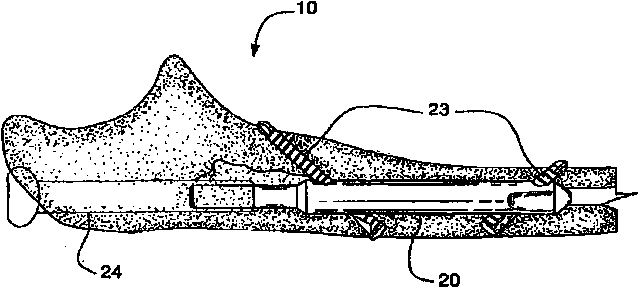 Nail system and method for an olecranon osteotomy