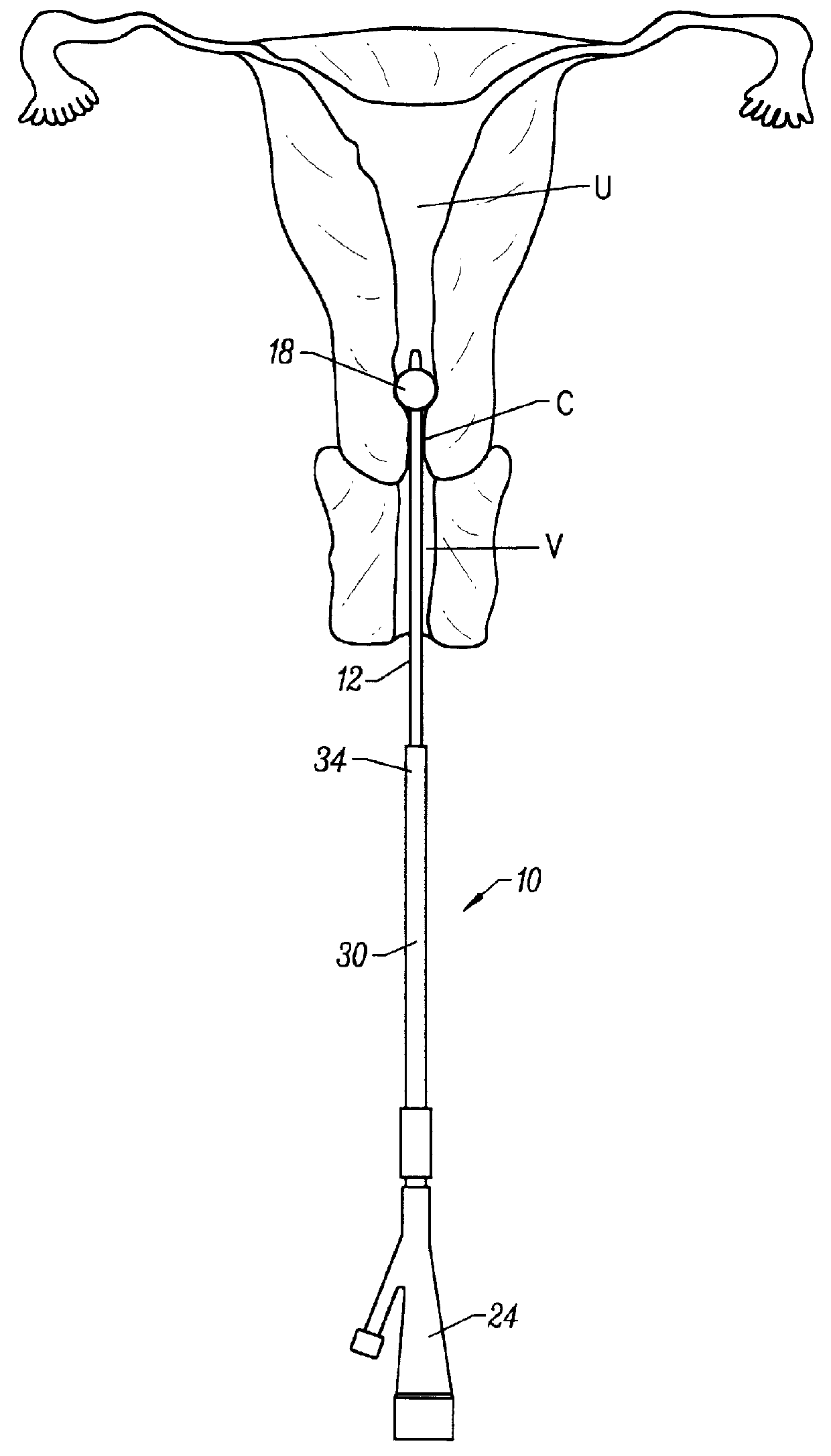 Method and apparatus for performing hysterosalpingography