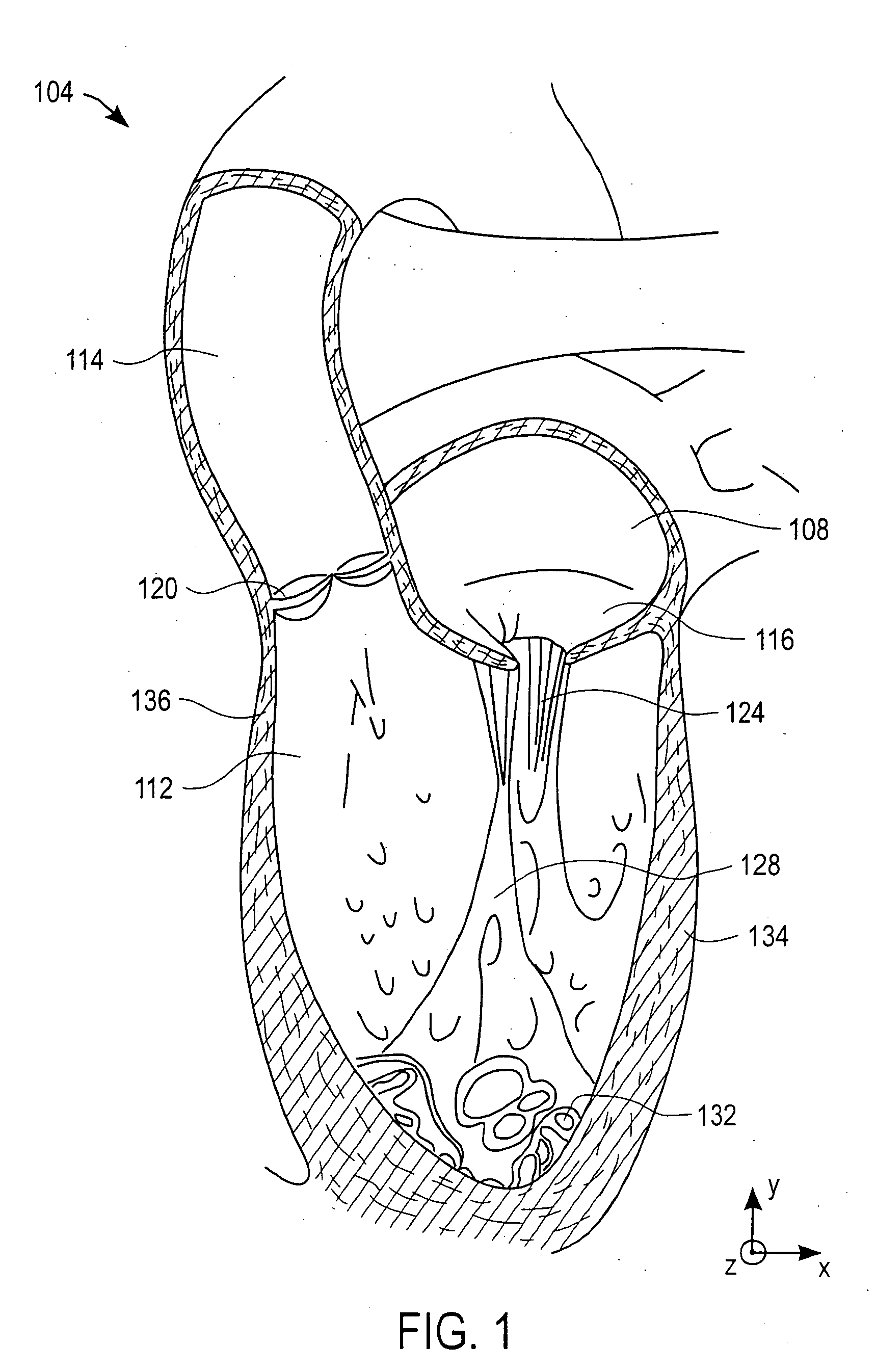 Method and apparatus for performing catheter-based annuloplasty using local plications