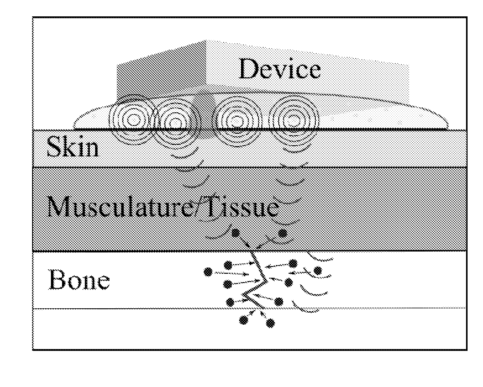 Method and device for non-invasive acoustic stimulation of stem cells and progenitor cells in a patient