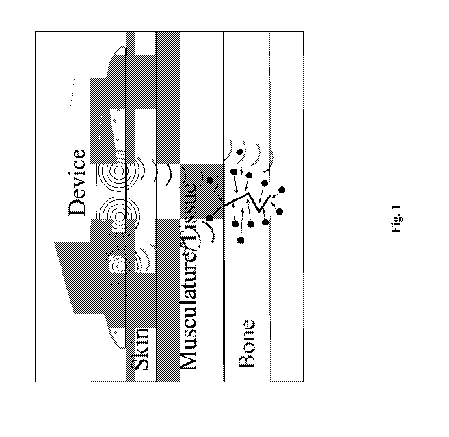 Method and device for non-invasive acoustic stimulation of stem cells and progenitor cells in a patient