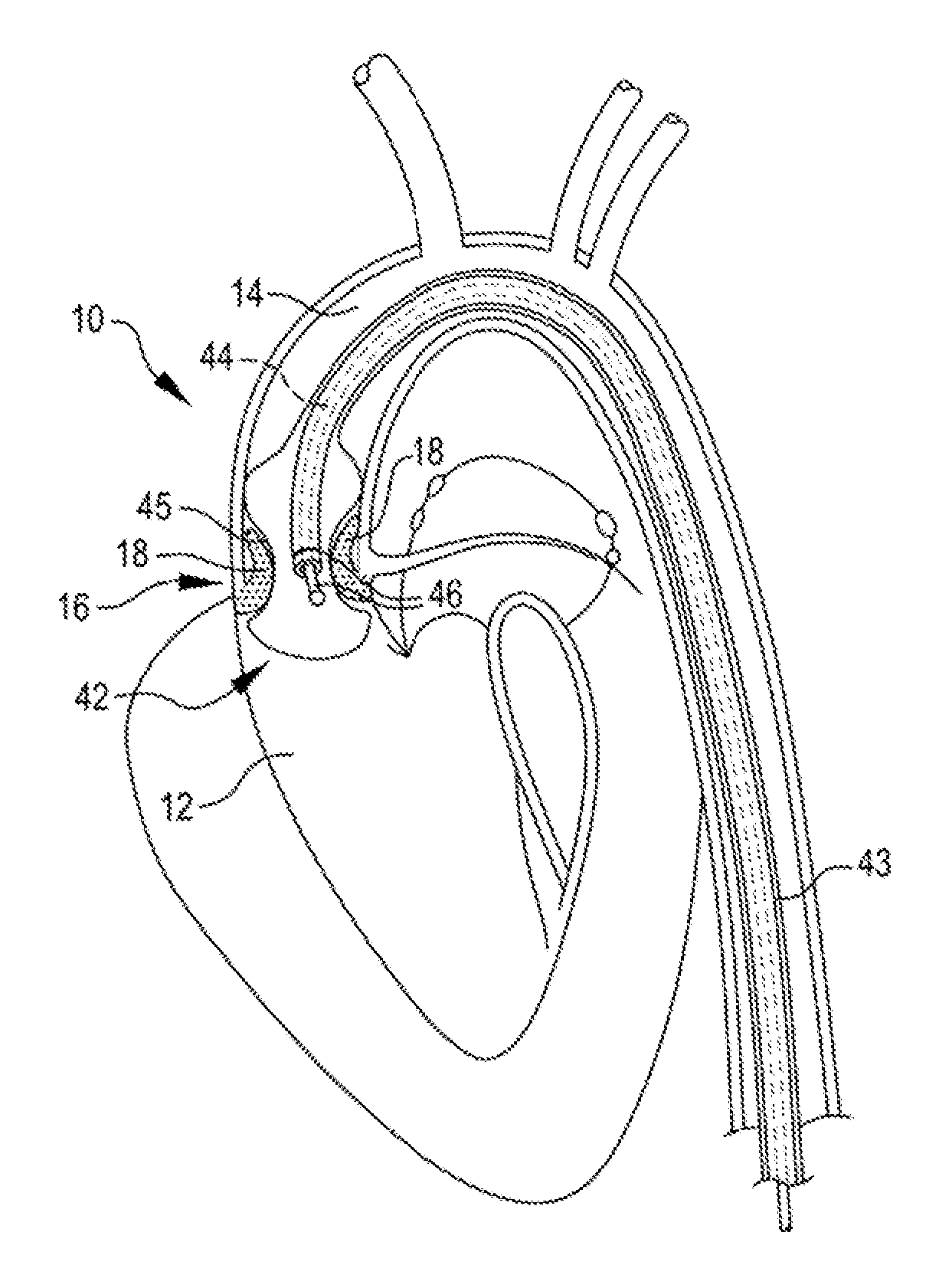 Shockwave valvuloplasty catheter system