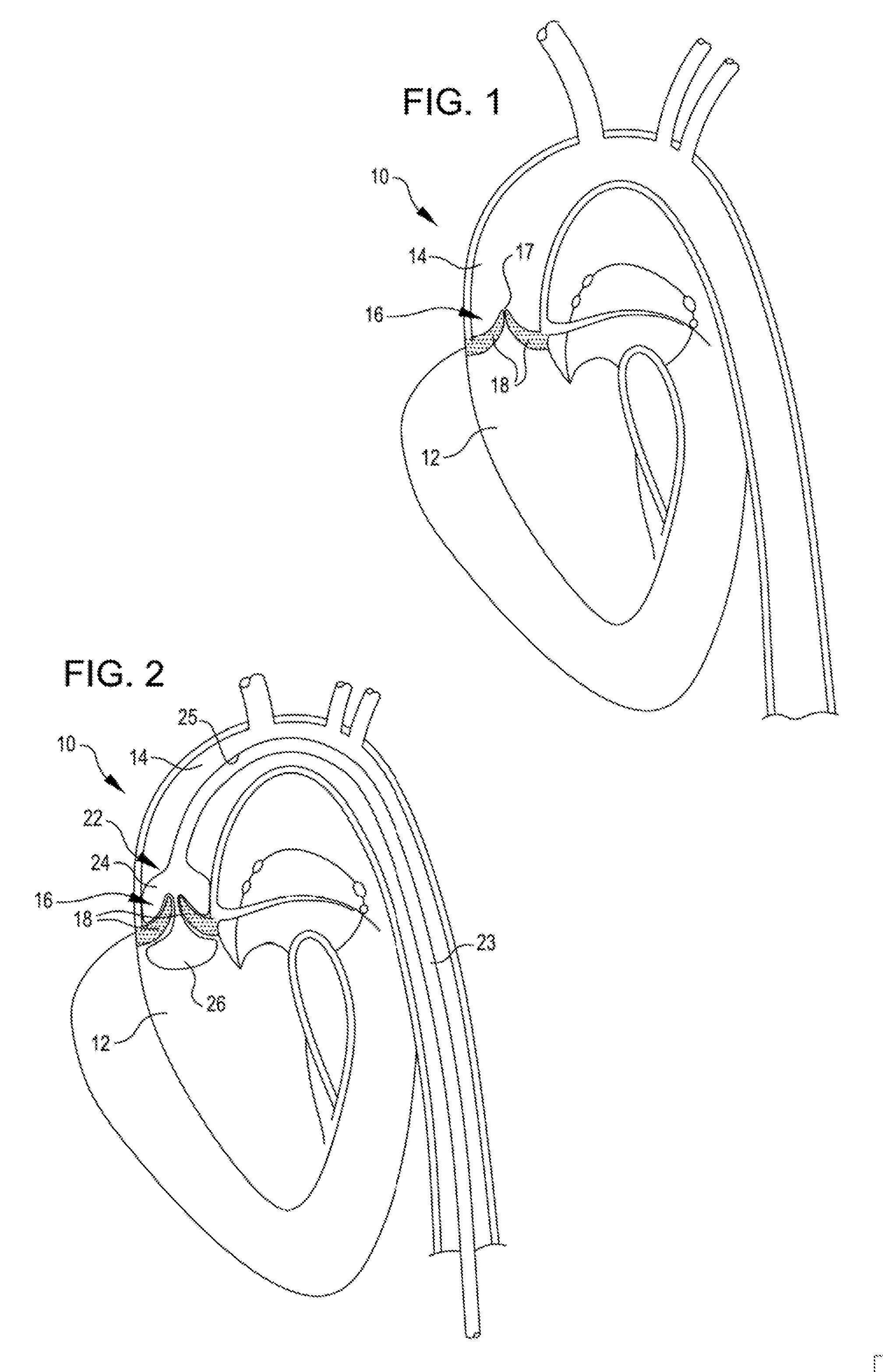 Shockwave valvuloplasty catheter system