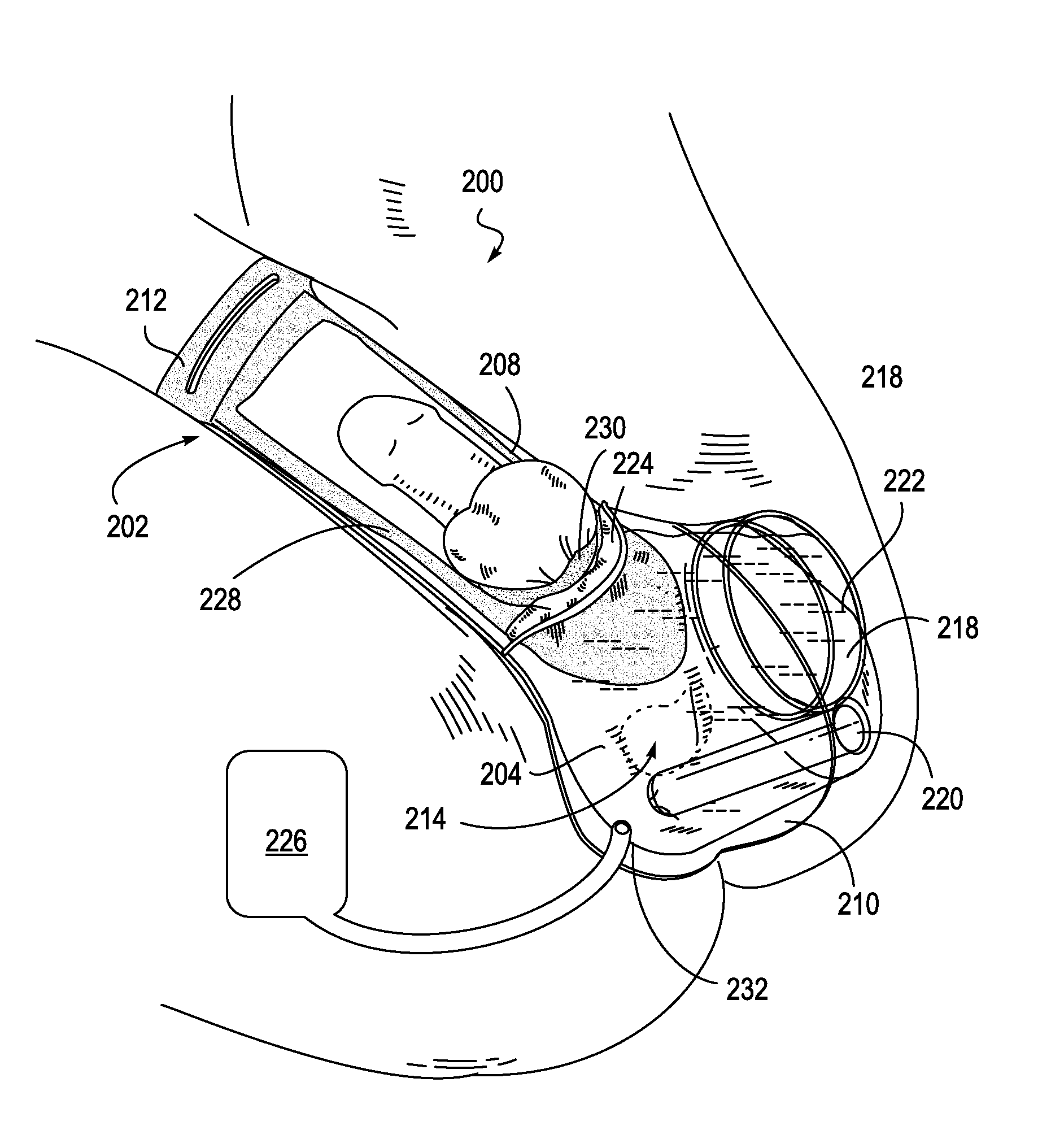 Disposable Acoustic Coupling Medium Container