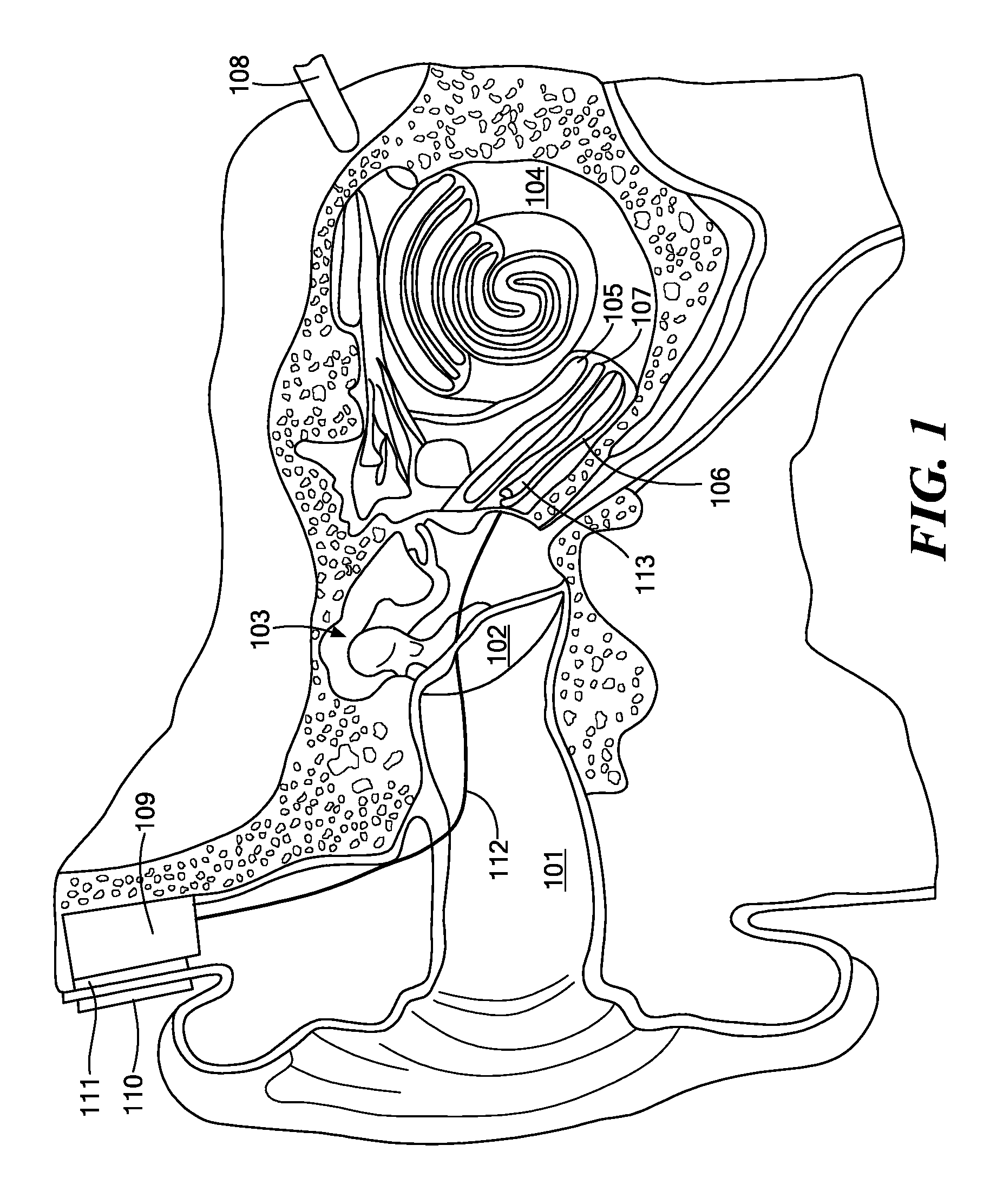 Cochlear implant pitch intensity