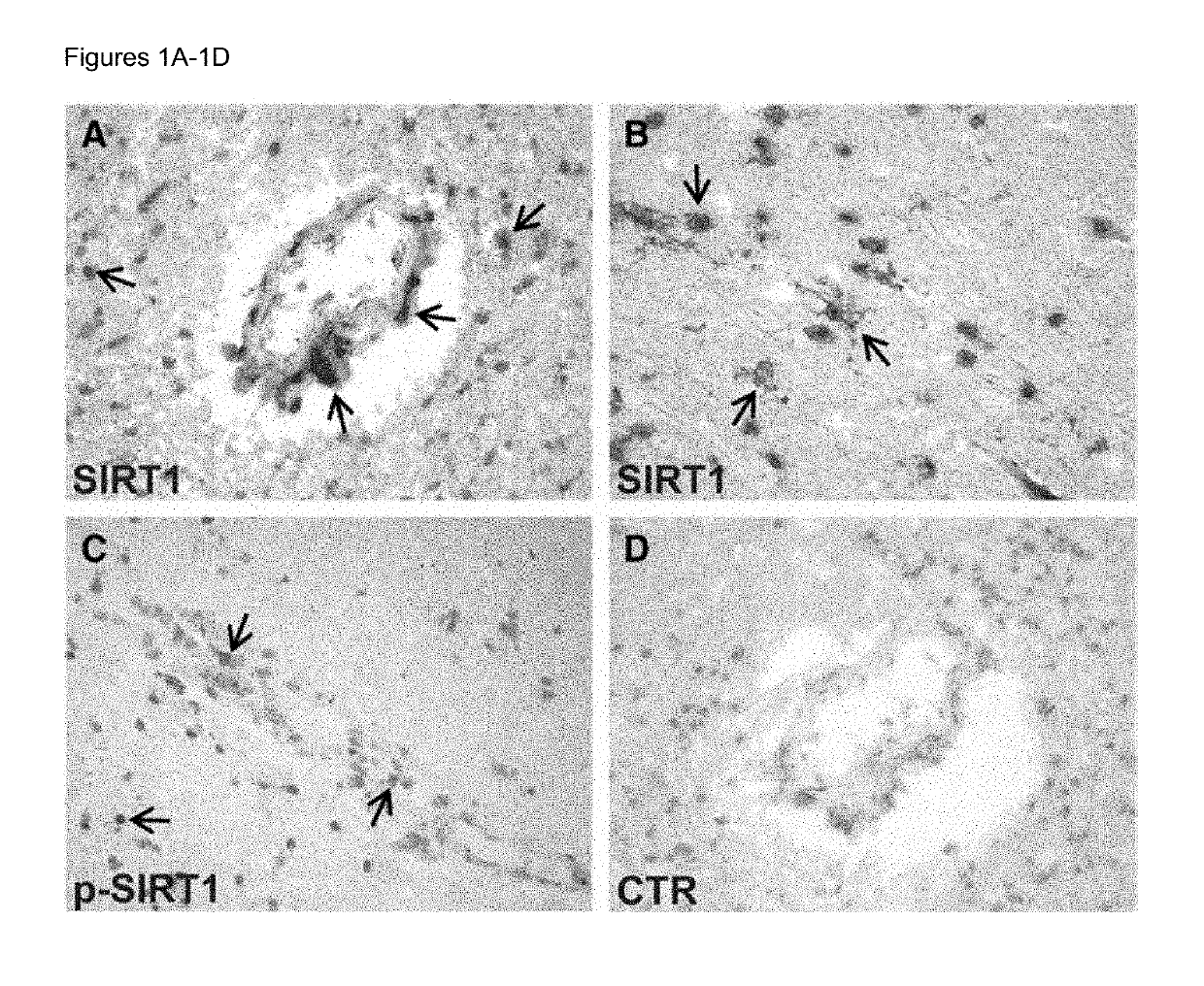 Biomarkers for predicting relapse in multiple sclerosis