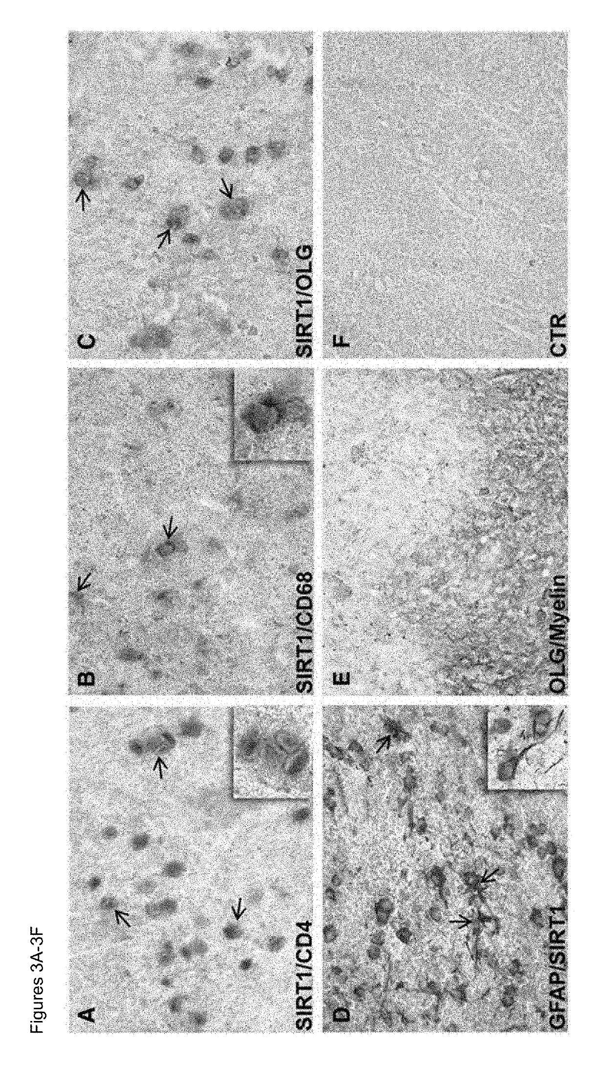 Biomarkers for predicting relapse in multiple sclerosis