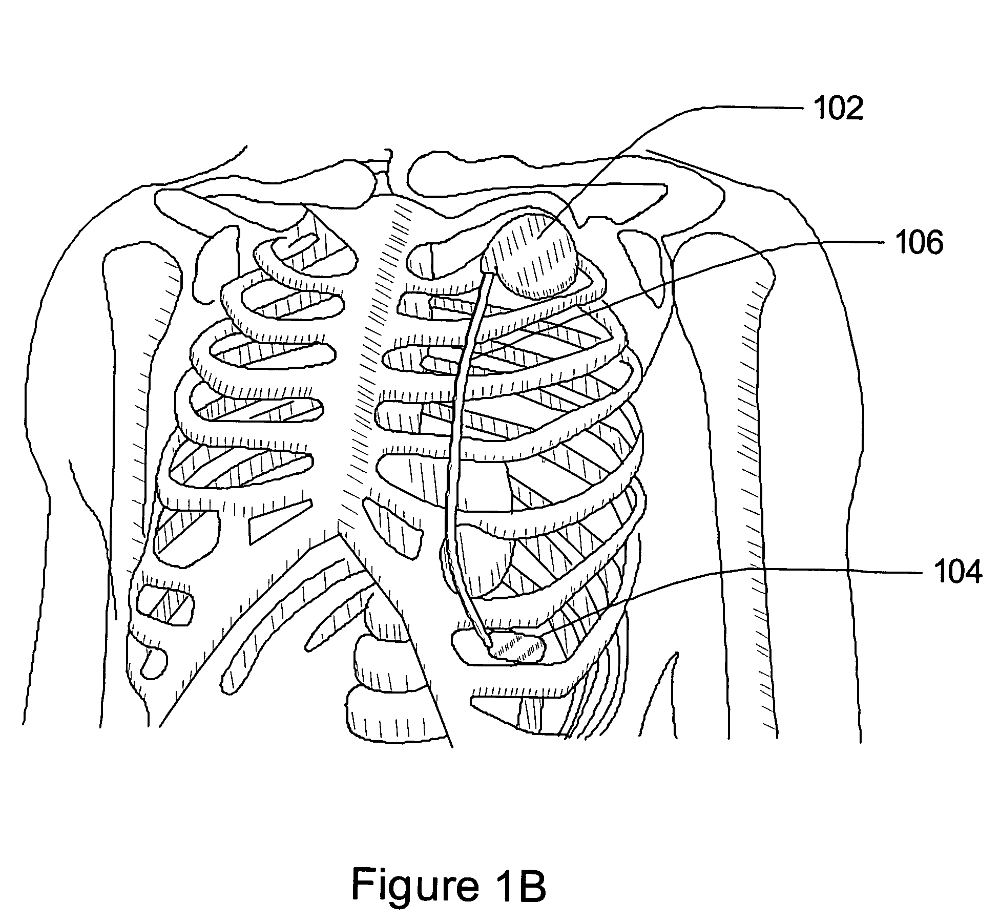 Subcutaneous cardiac stimulation system with patient activity sensing