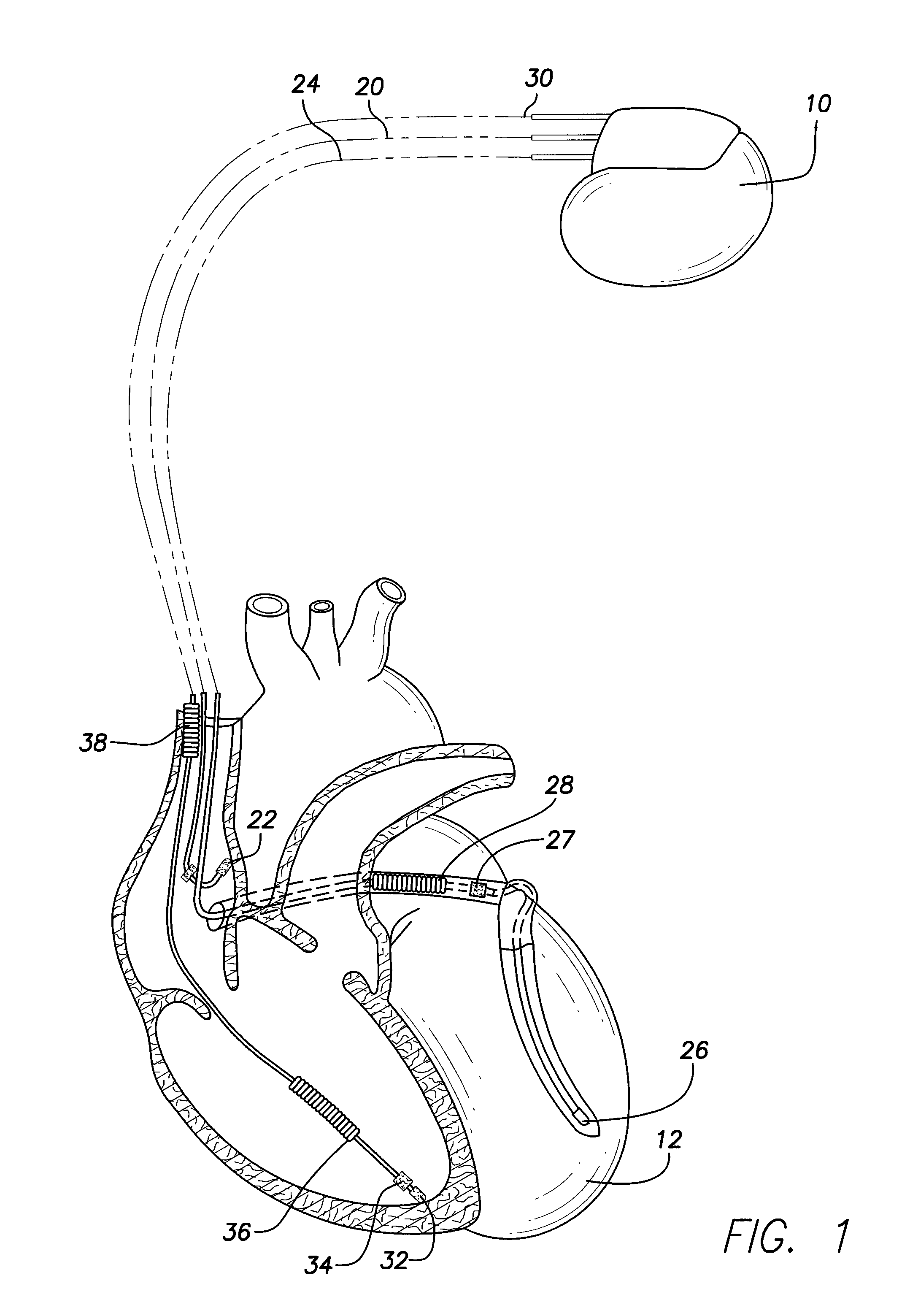 Method and system for detecting and treating junctional rhythms