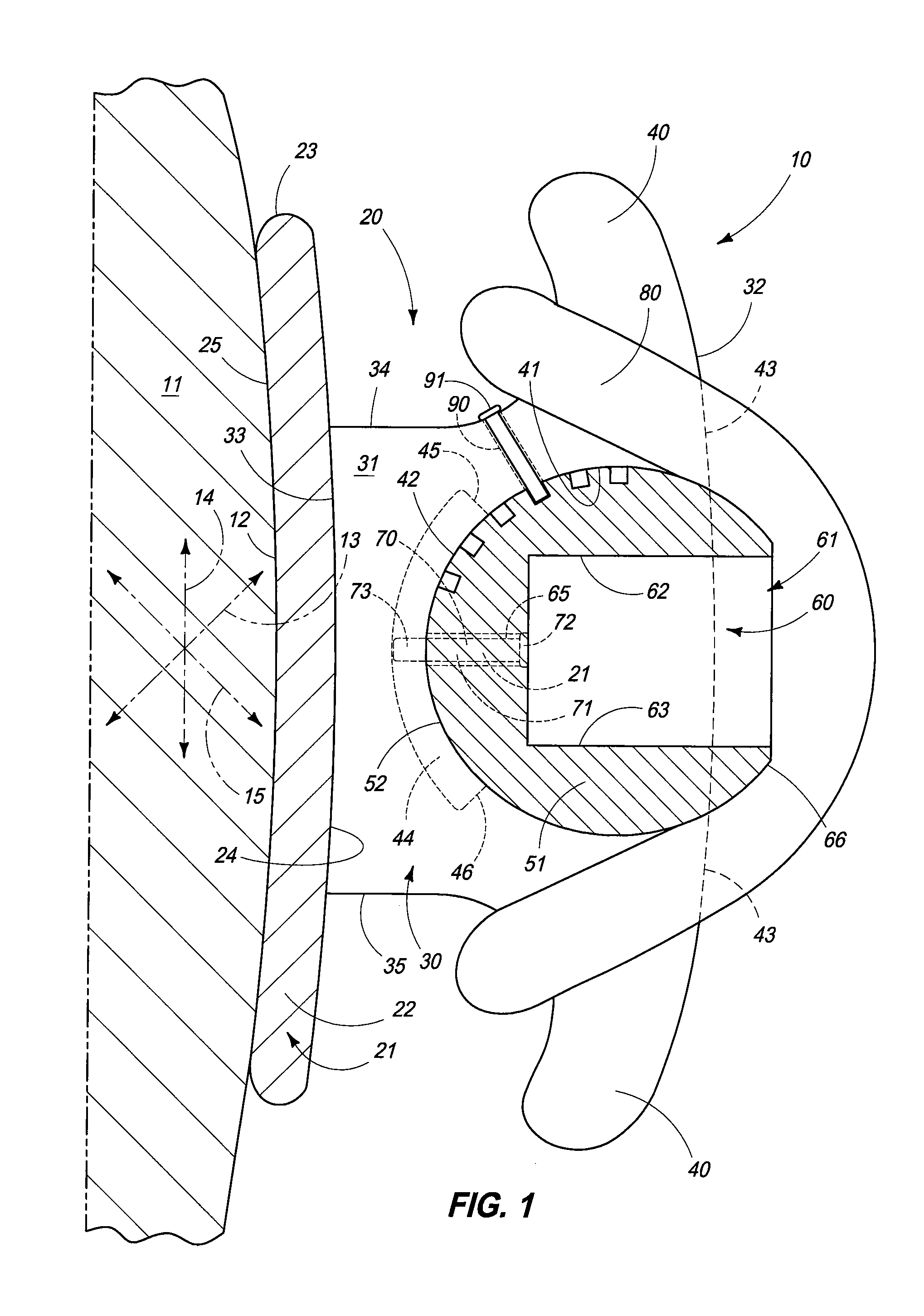 Orthodontic Bracket