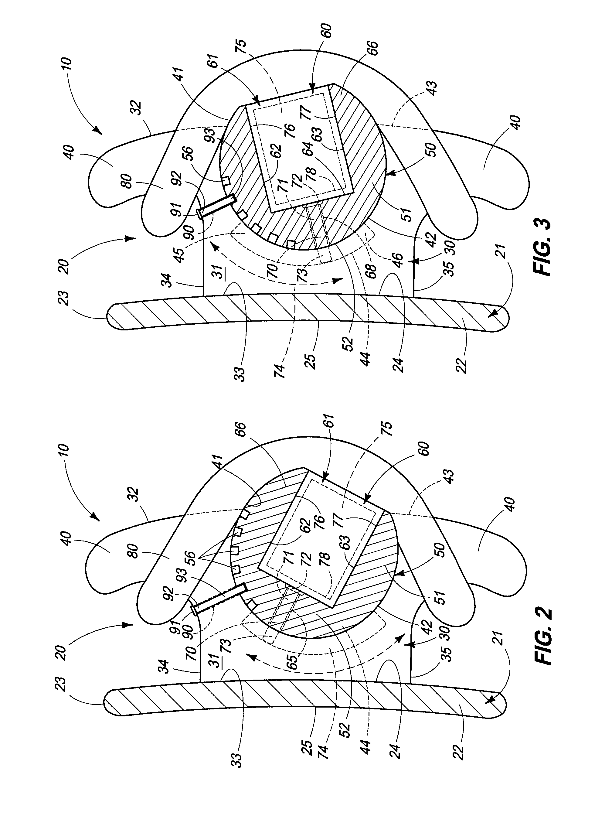 Orthodontic Bracket