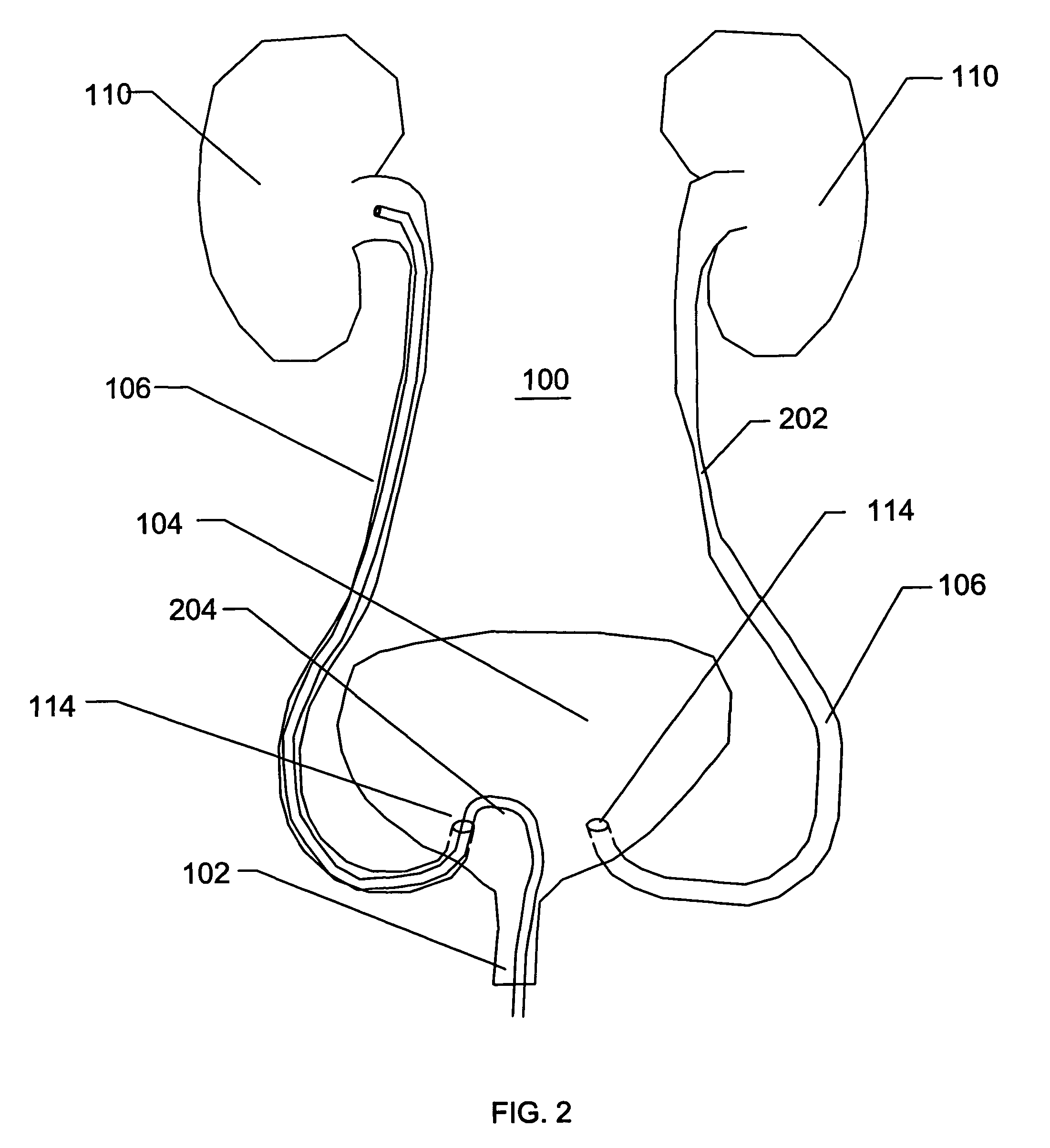 Expandable transluminal sheath