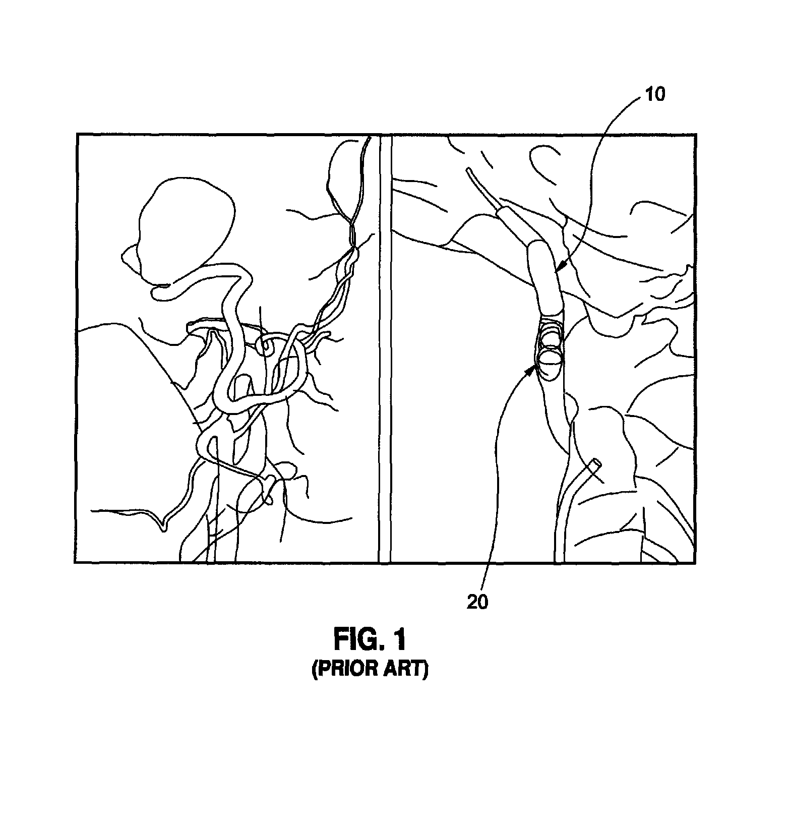 Methods and apparatus for rapid endovascular vessel occlusion and blood flow interruption