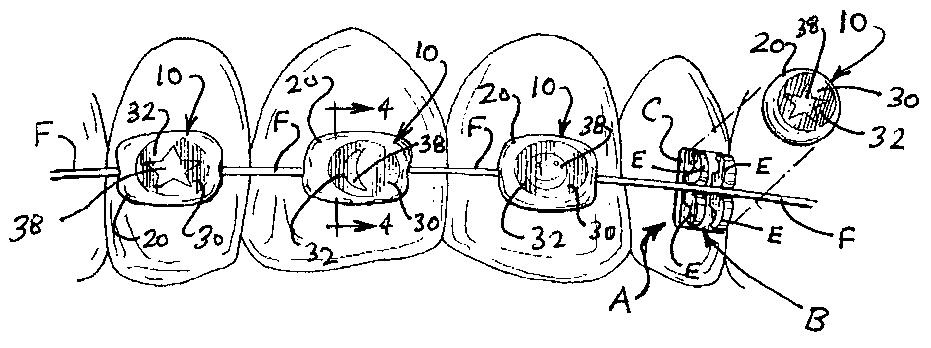 Elastomeric orthodontic ligator