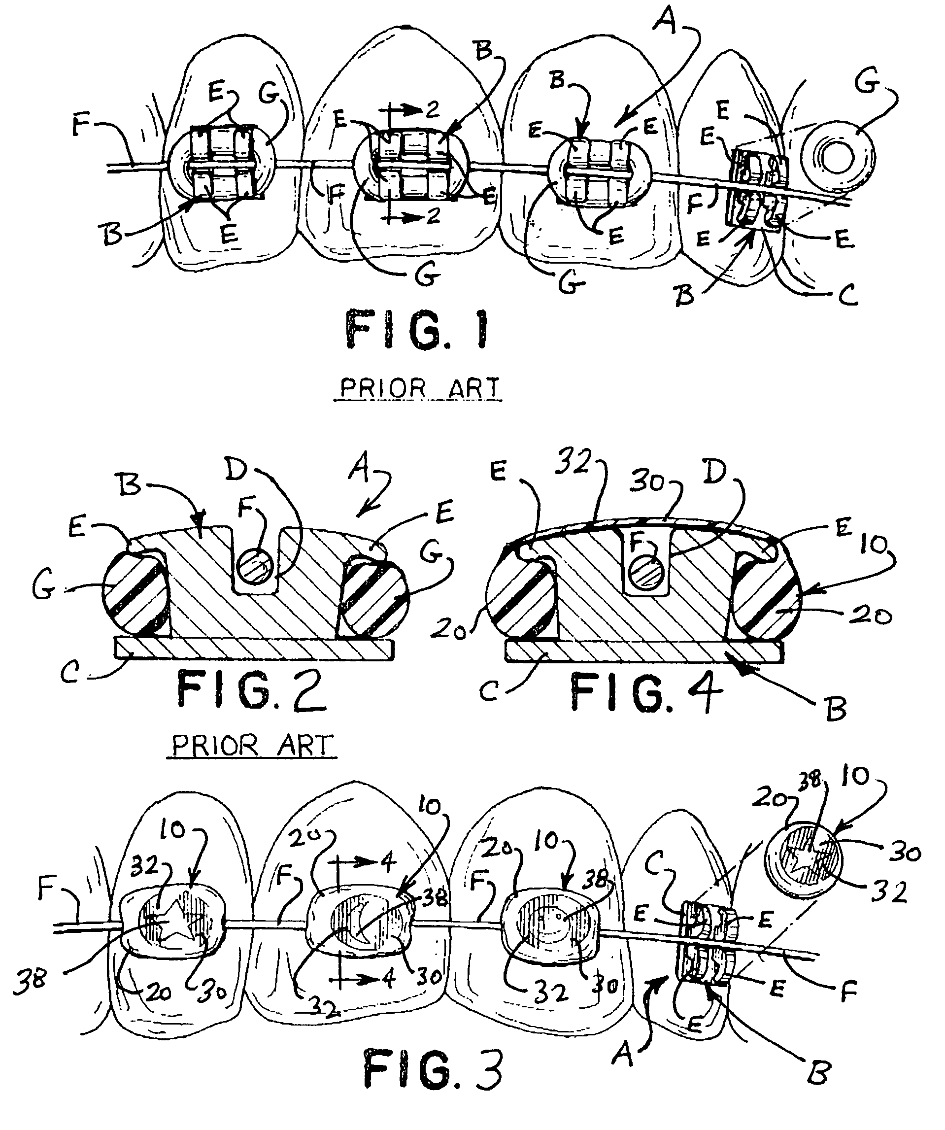 Elastomeric orthodontic ligator