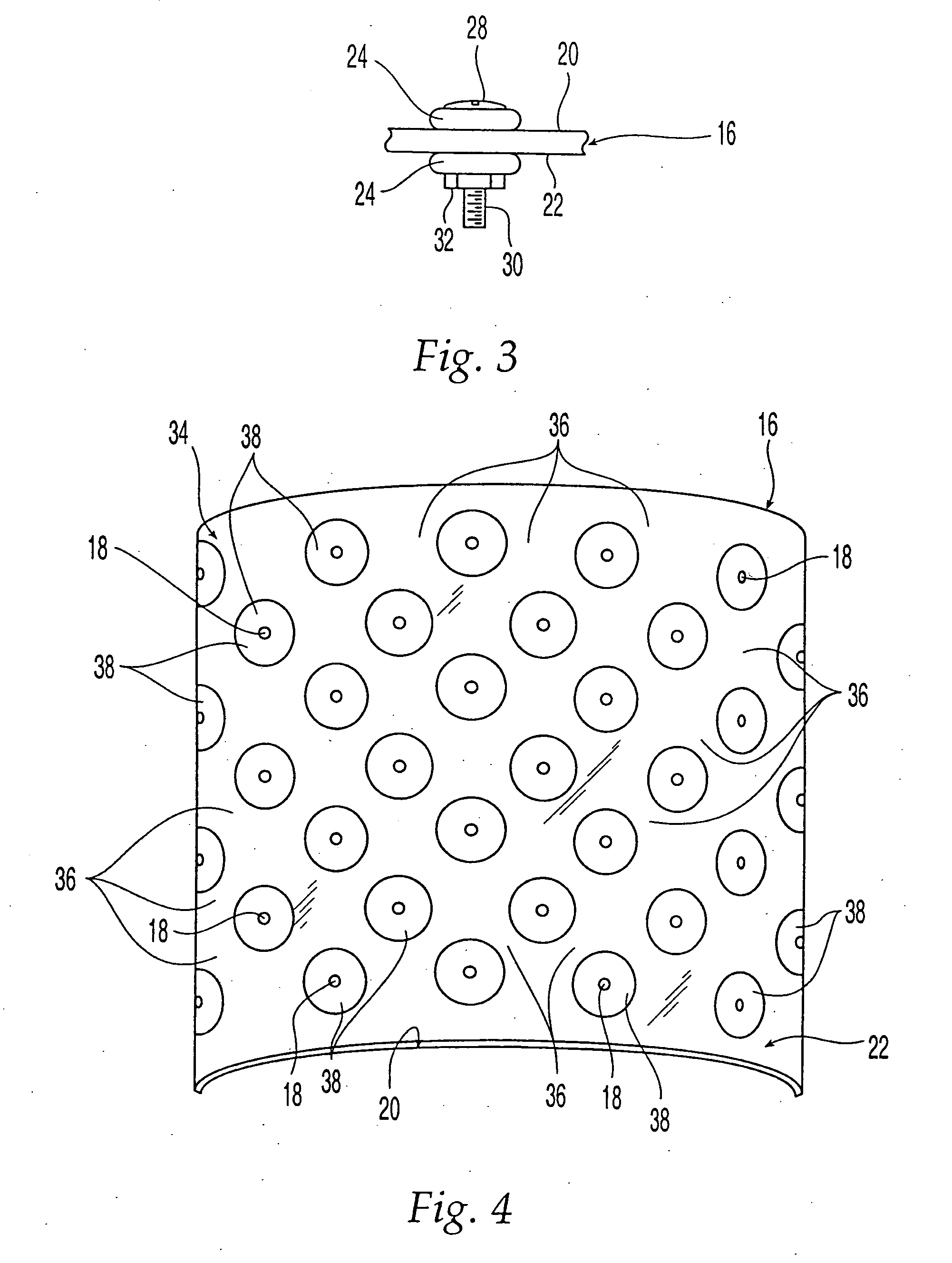 Demineralized bone-derived implants