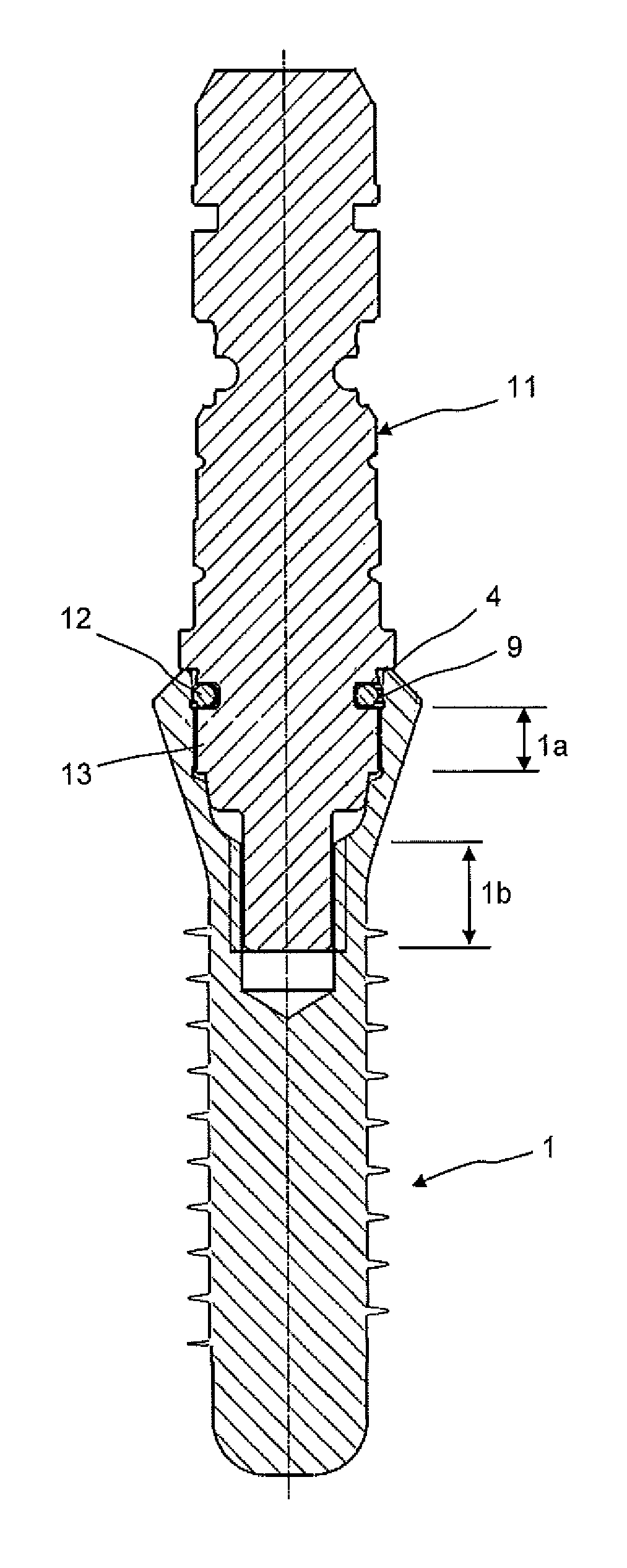 Dental implant socket arrangement with annular recess