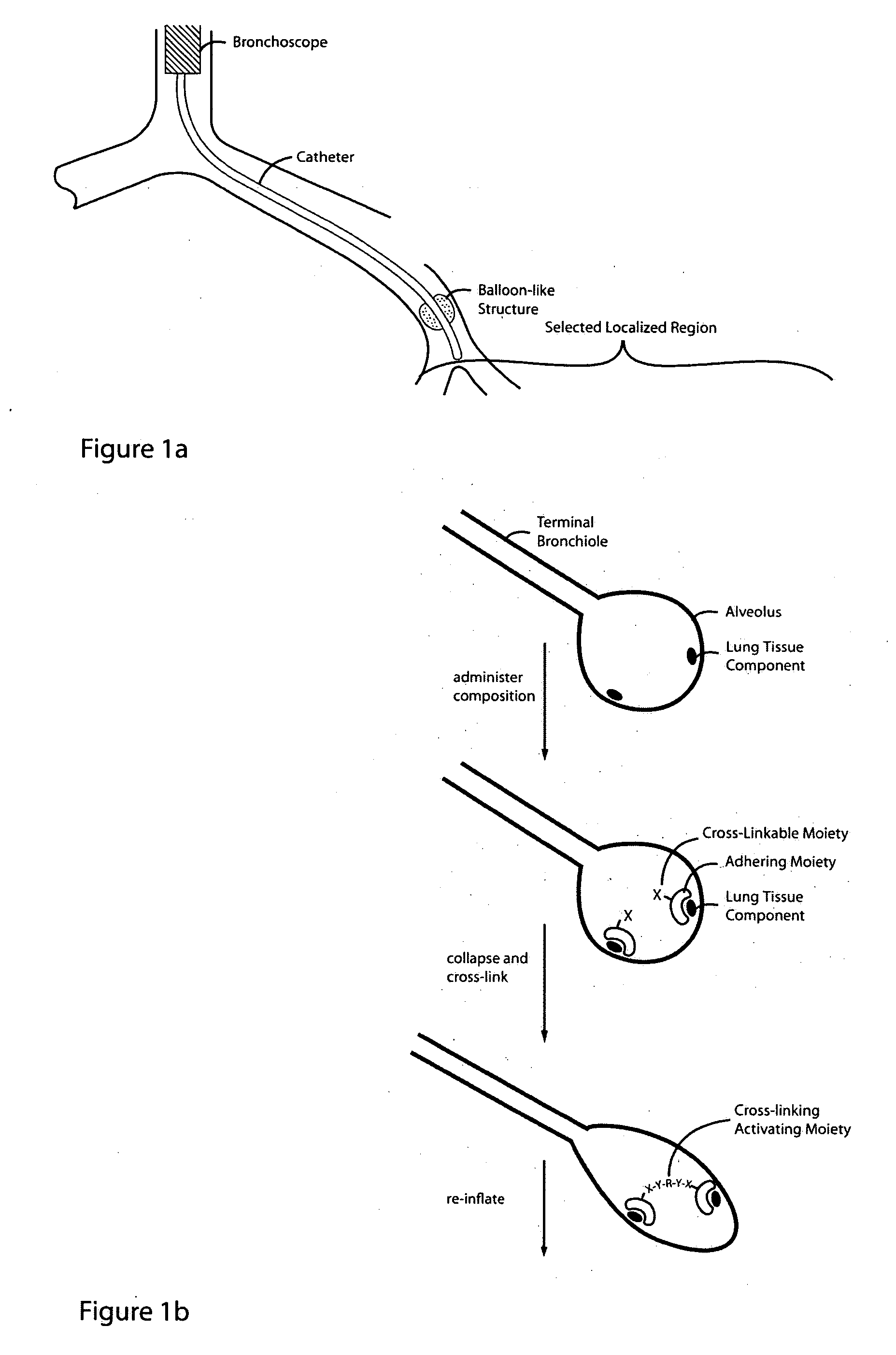 Glue composition for lung volume reduction