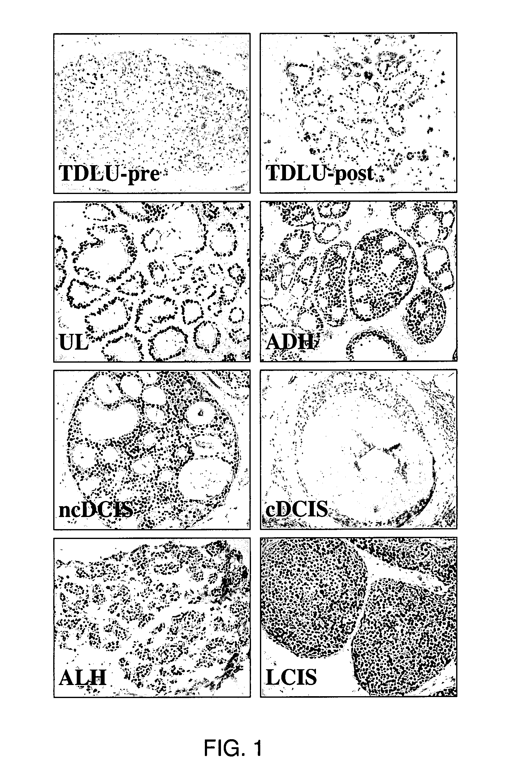 Methods and compositions in breast cancer diagnosis and therapeutics