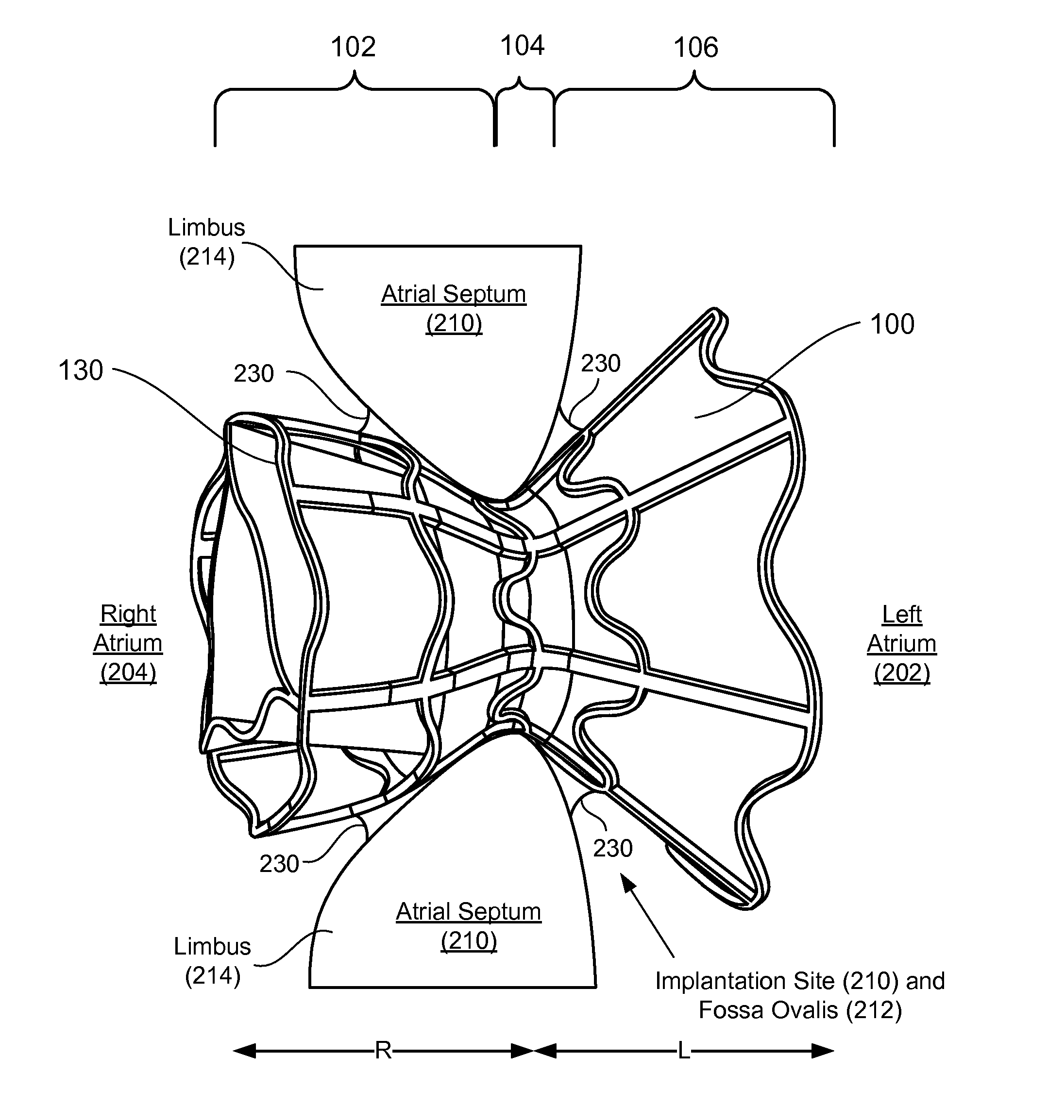 Apparatus and methods for delivering devices for reducing left atrial pressure