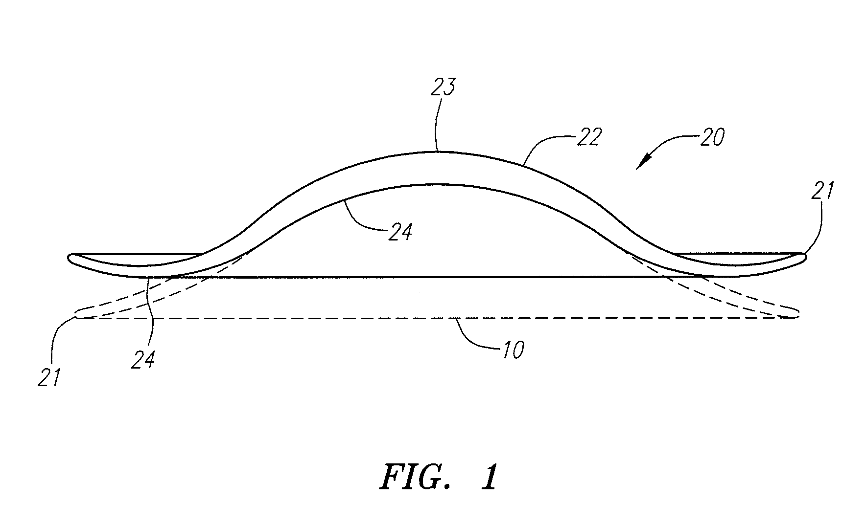 Small Diameter Inlays