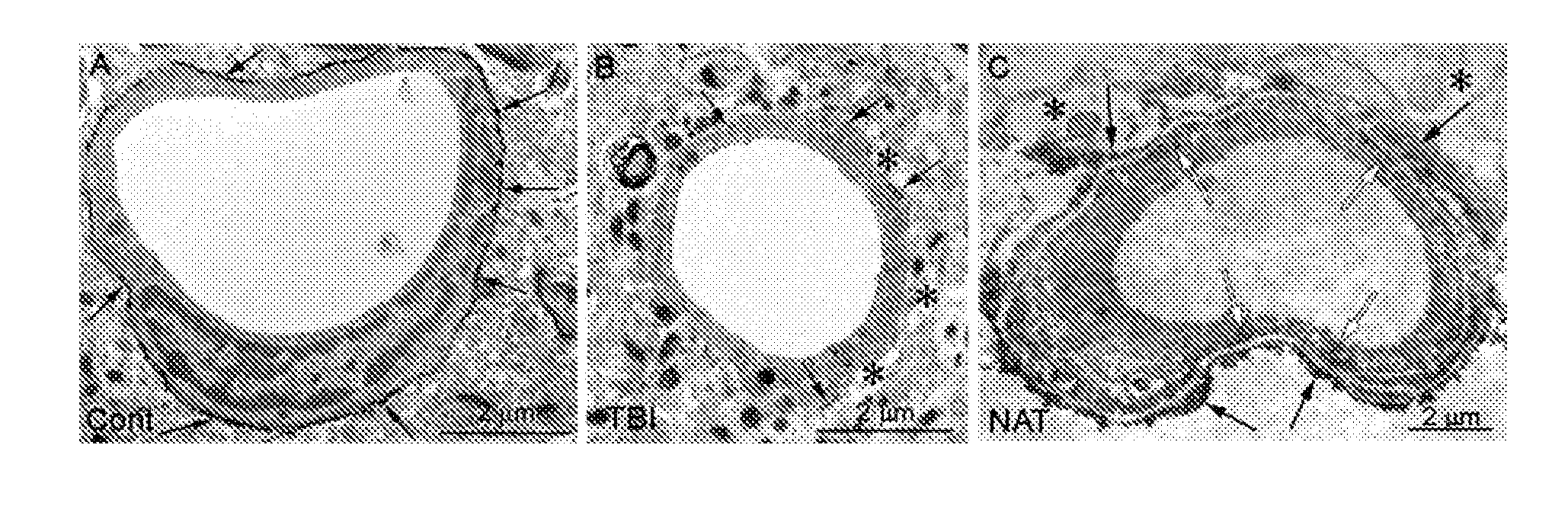 Method for reducing intracranial pressure