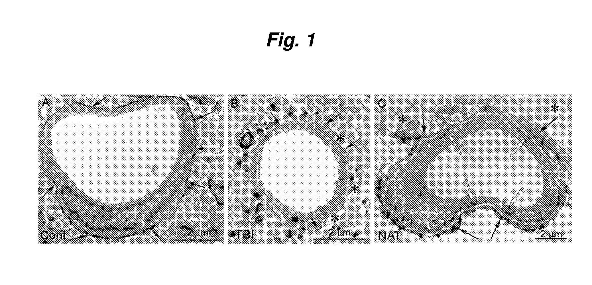 Method for reducing intracranial pressure